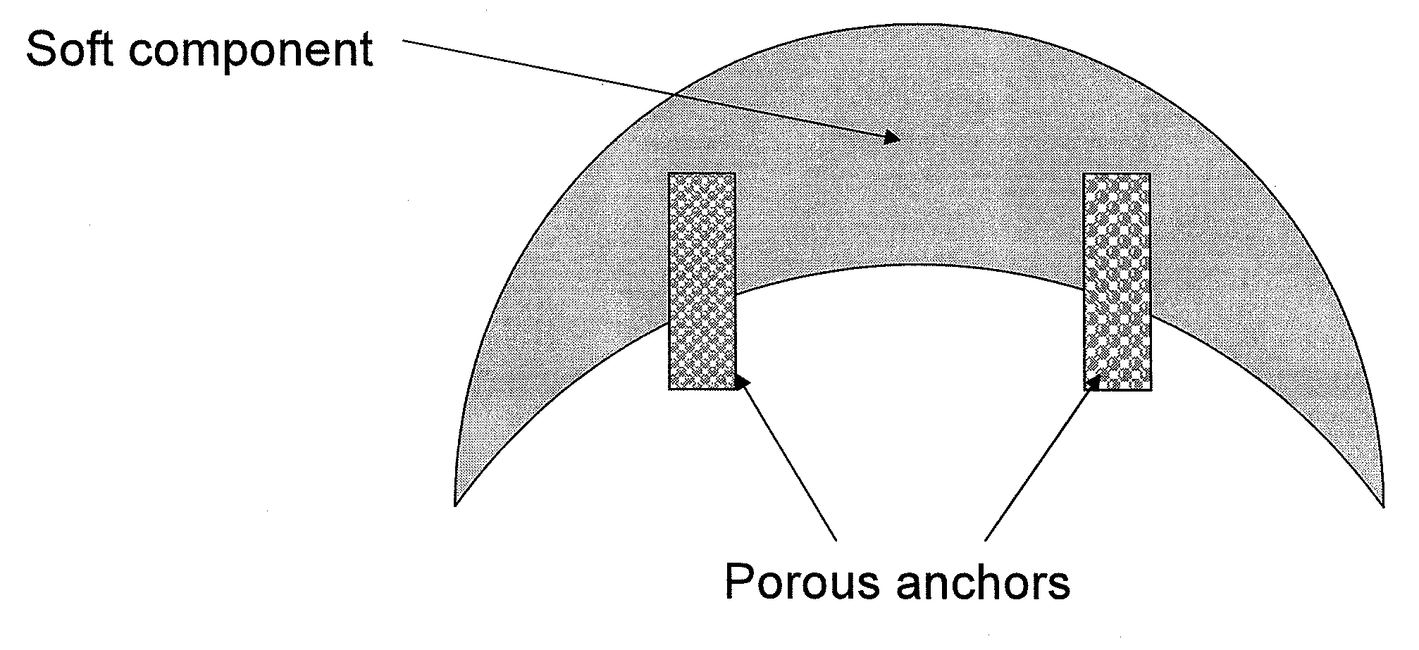 Composite Implants and Methods of Making and Using the Same