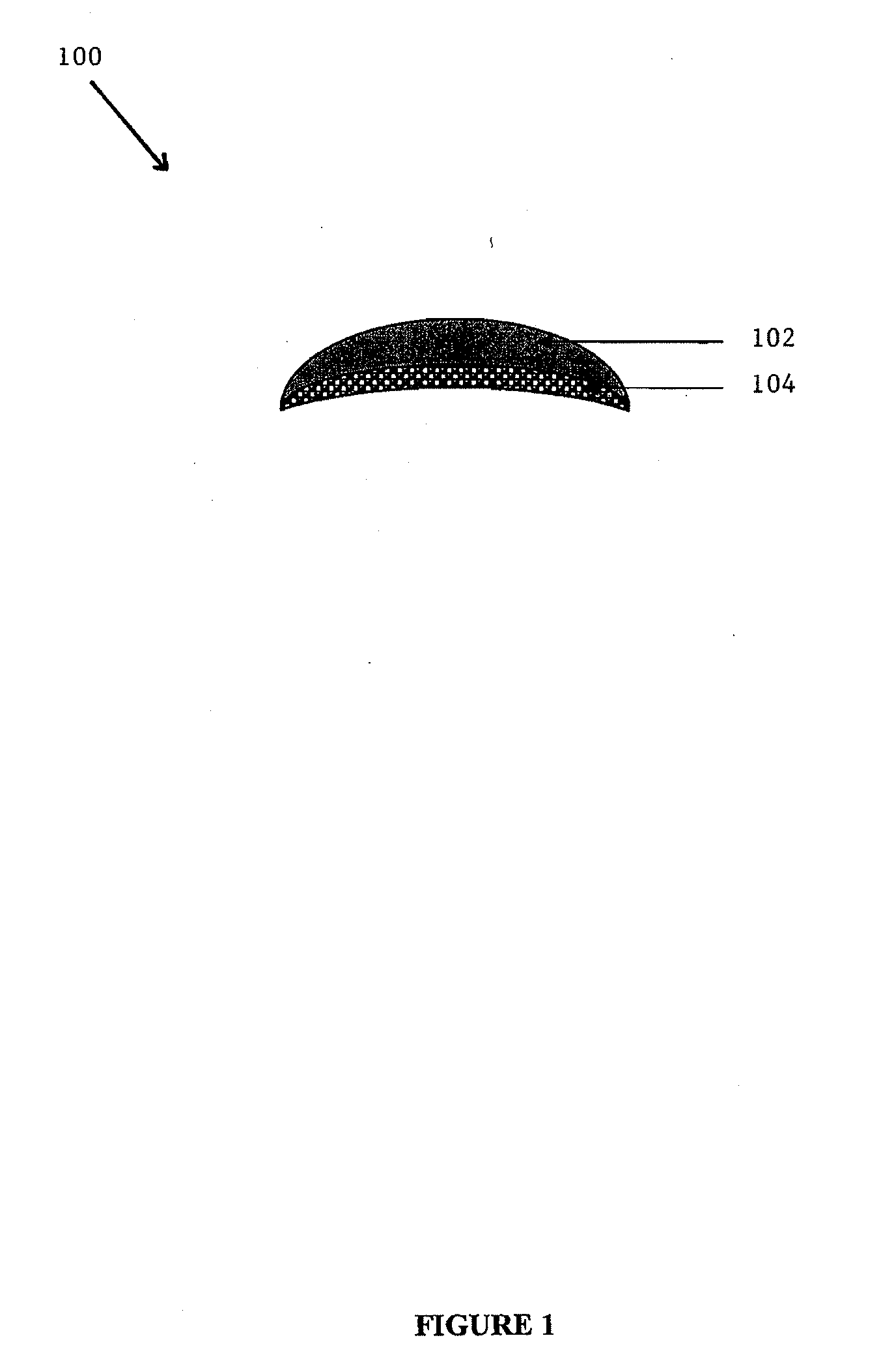 Composite Implants and Methods of Making and Using the Same