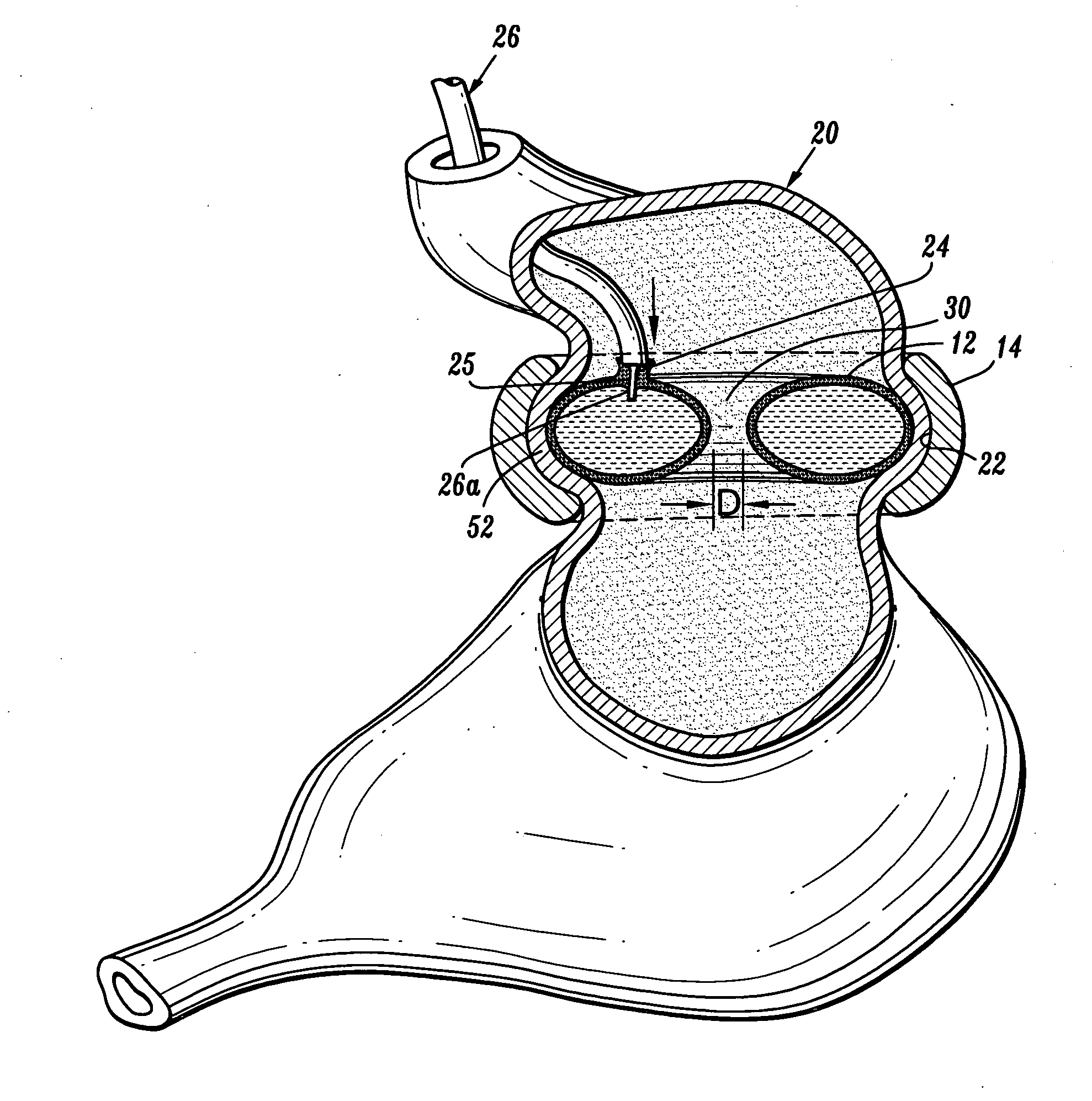 Gastric restrictor assembly and method of use