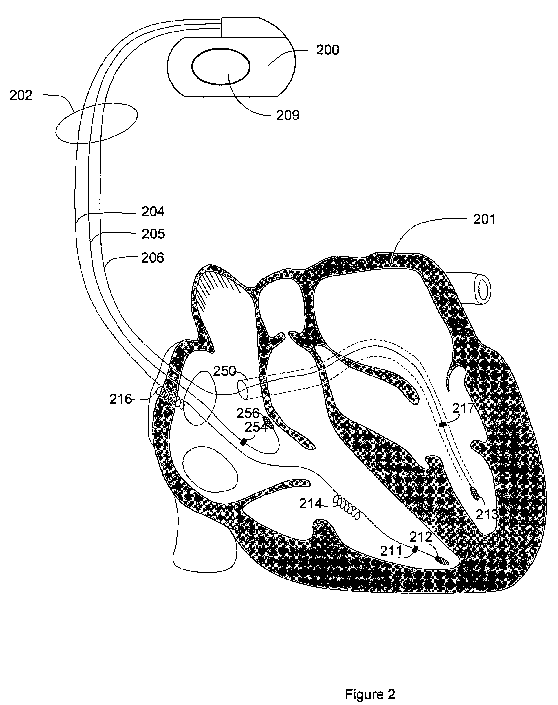 Blending cardiac rhythm detection processes