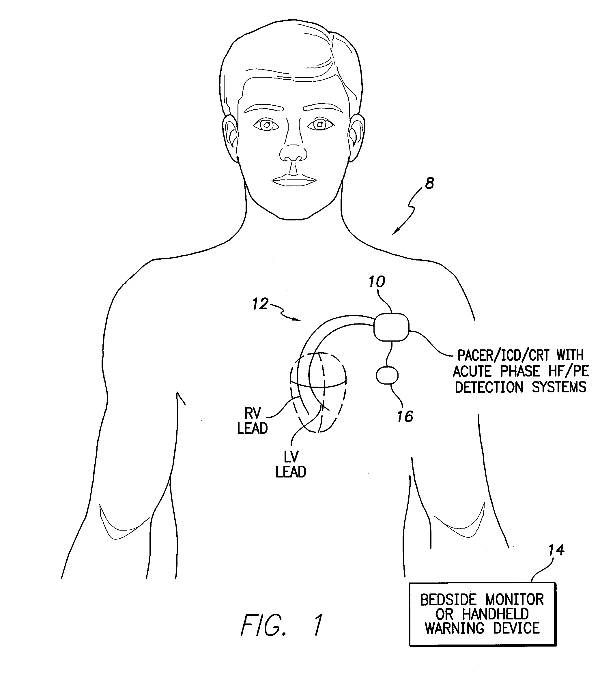 Systems and Methods for Activating and Controlling Impedance-Based Detection Systems of Implantable Medical Devices