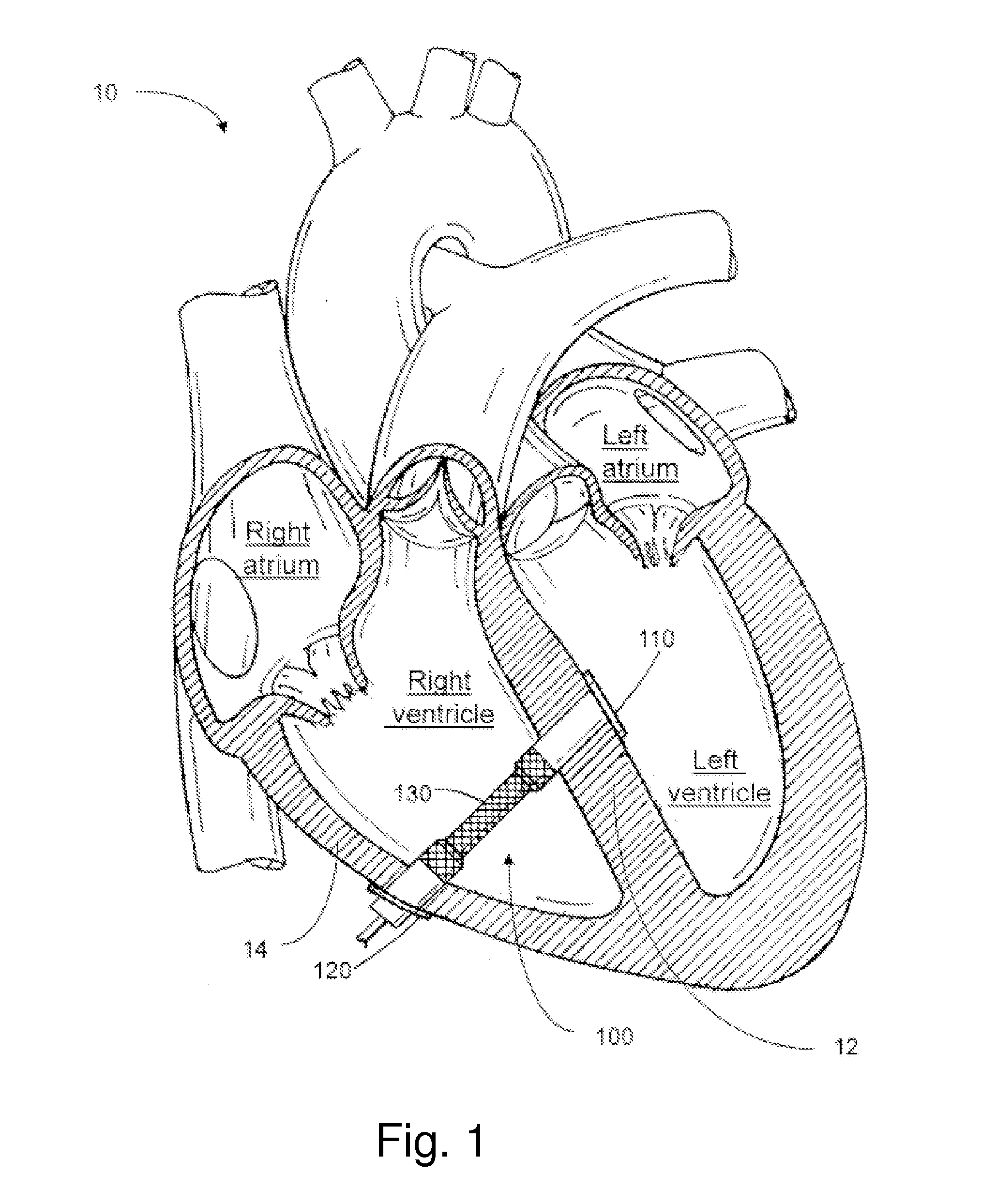 Mechanical assist device