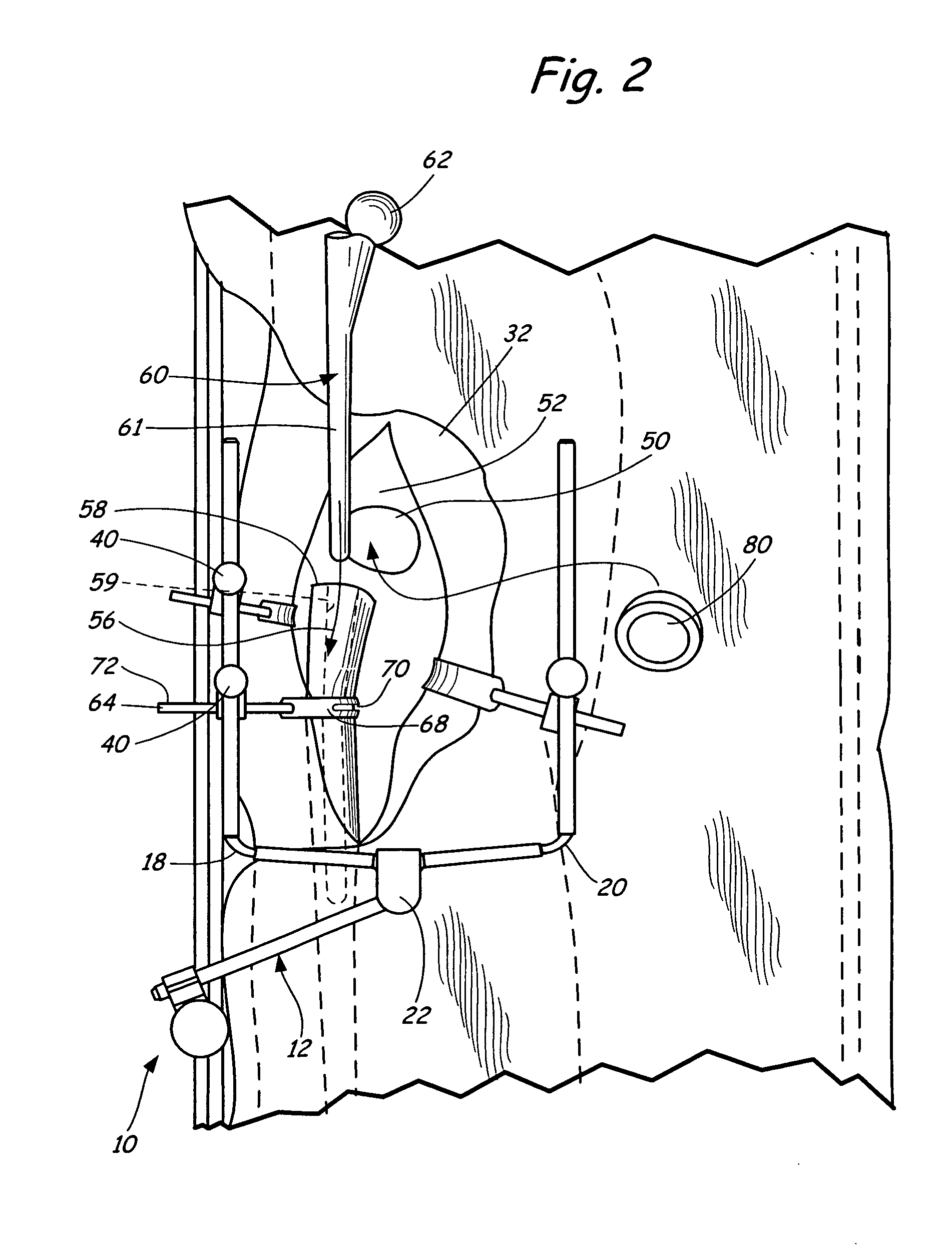 Method of table mounted retraction in hip surgery