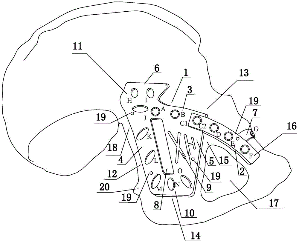 Fixing device for fractures of anterior column, posterior column and square area of acetabulum and method