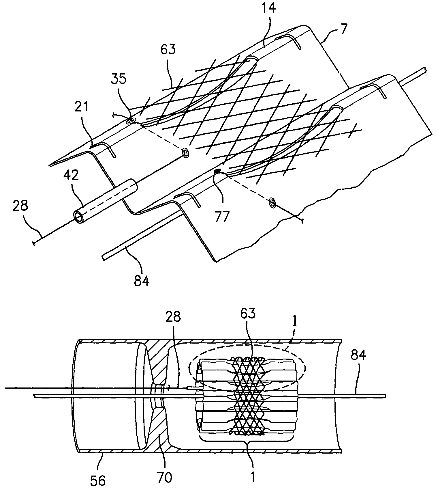 Flow maintaining stent delivery system