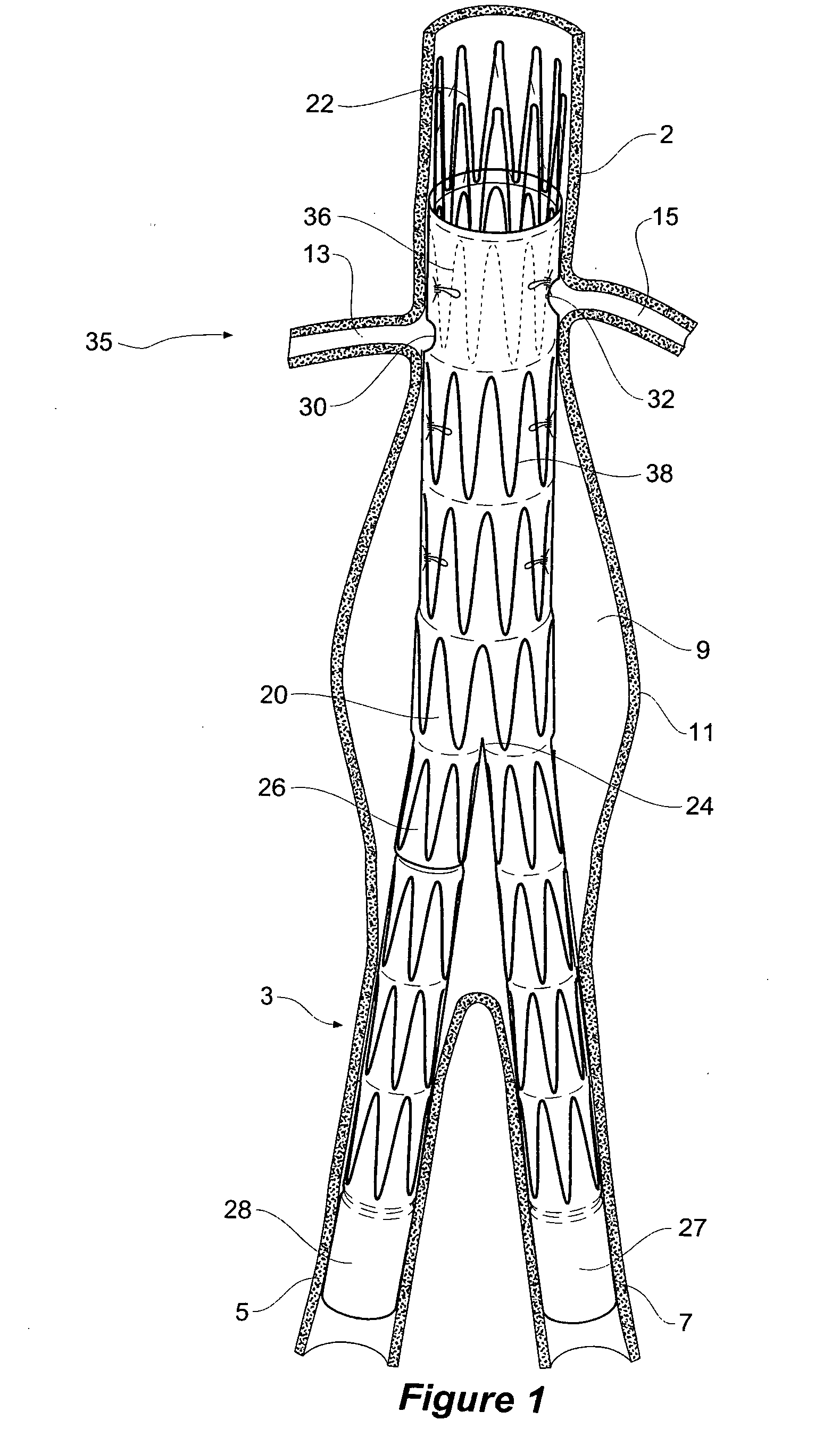 Design and assembly of fenestrated stent grafts