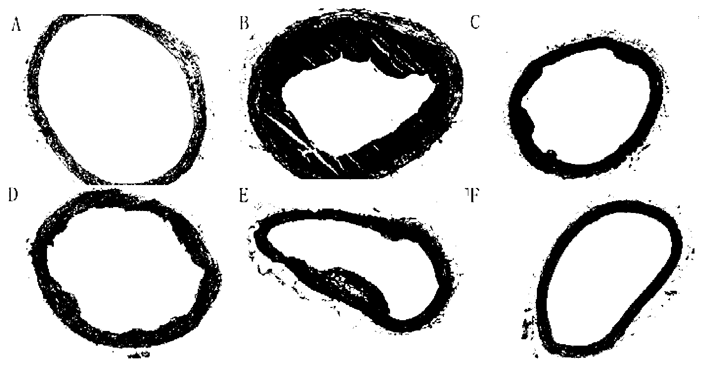 Purposes of artemisinin compounds in preparing anti-atherosclerotic medicaments