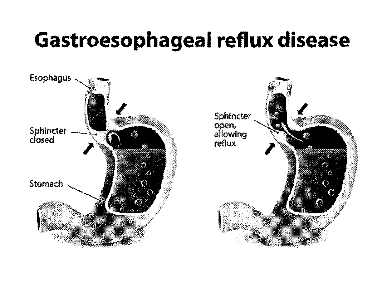 Method and system for reducing the likelihood of colorectal cancer in a human being