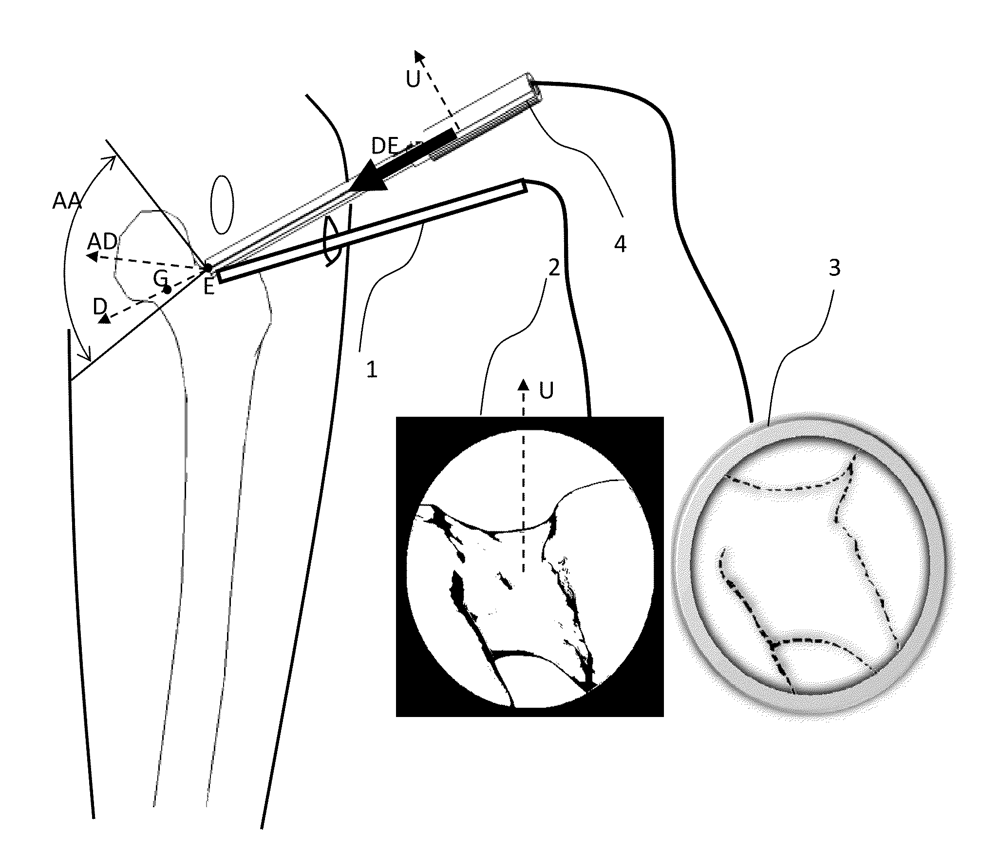 Method of determination of access areas from 3D patient images