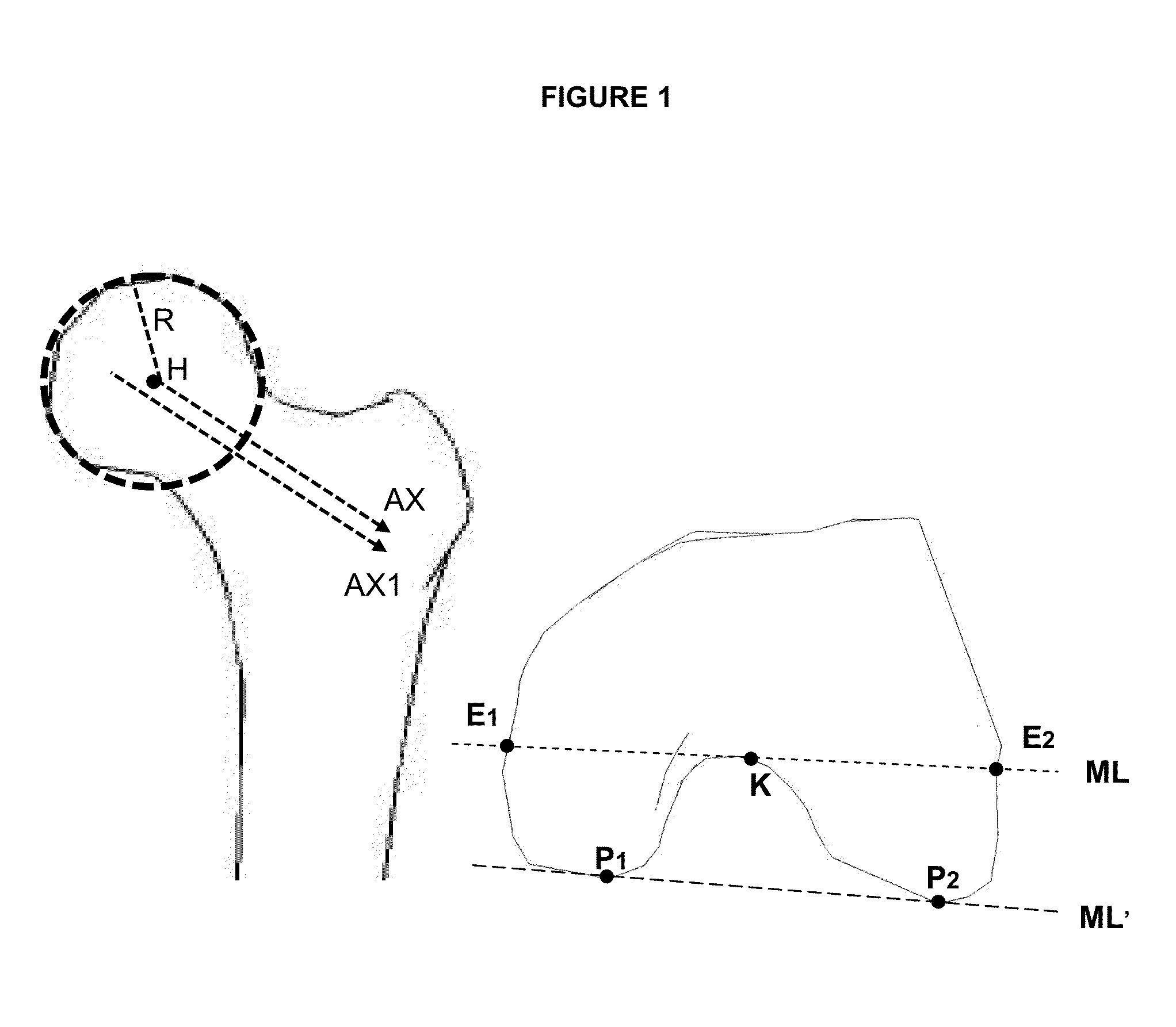 Method of determination of access areas from 3D patient images