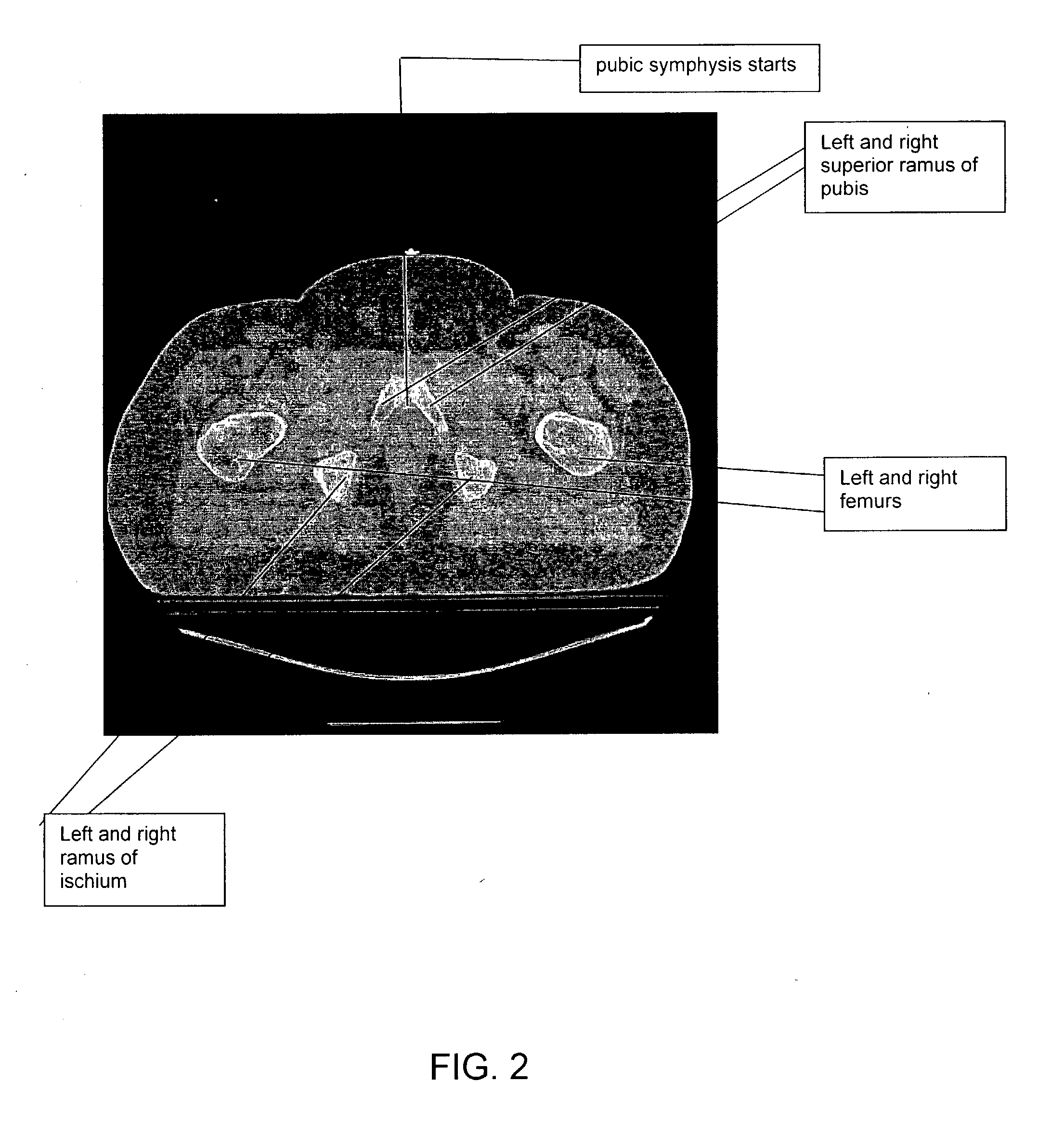 Automatic contouring of tissues in CT images