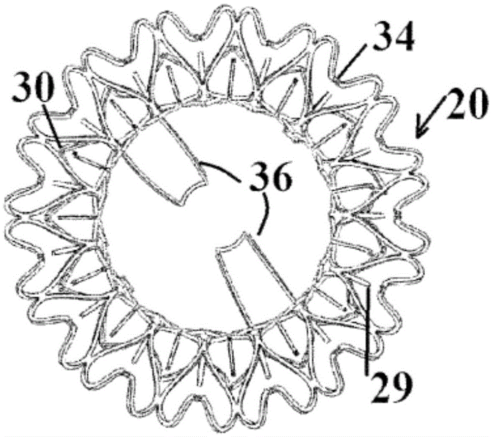 Device and method for mitral valve regurgitation method