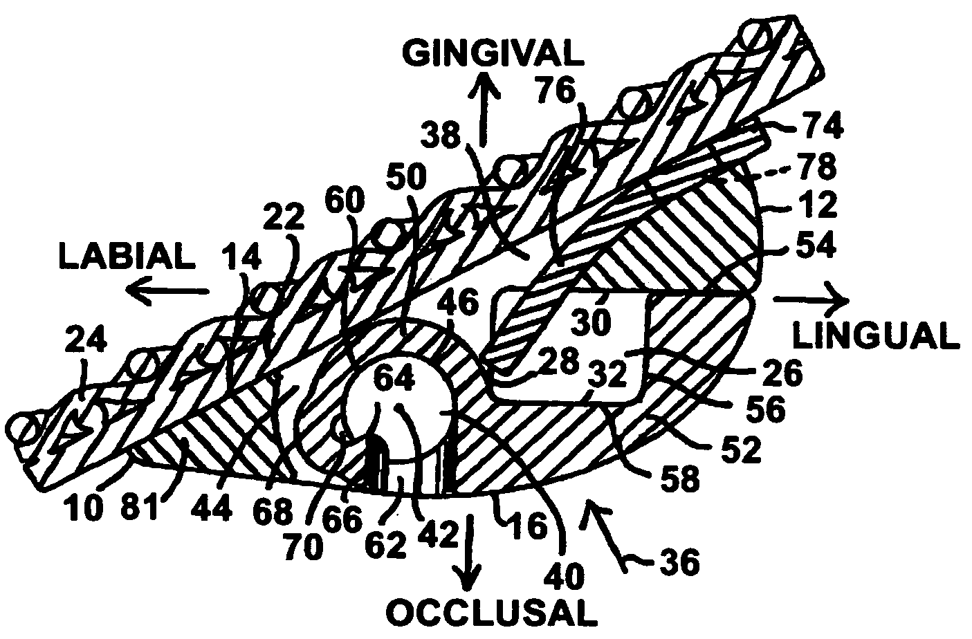 Orthodontic devices for use with arch wires