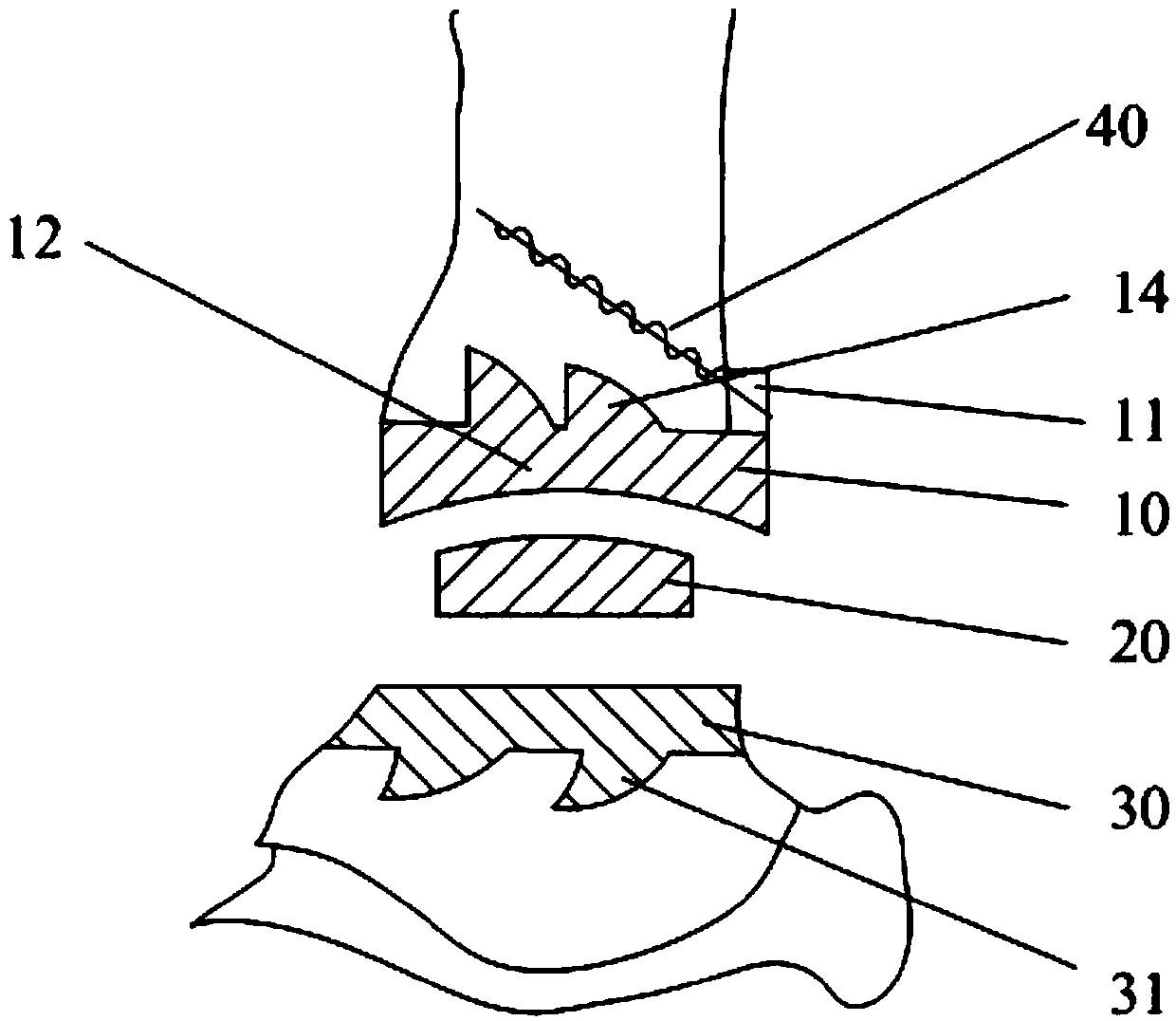 Single ankle joint surface replacement system