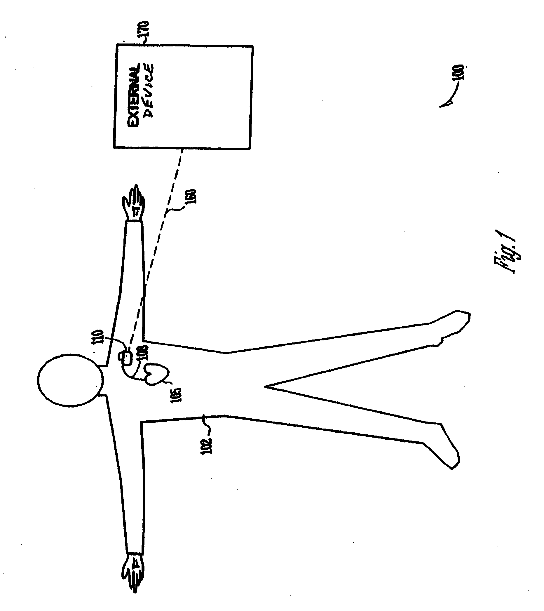 Zoneless tachyarrhythmia detection with real-time rhythm monitoring