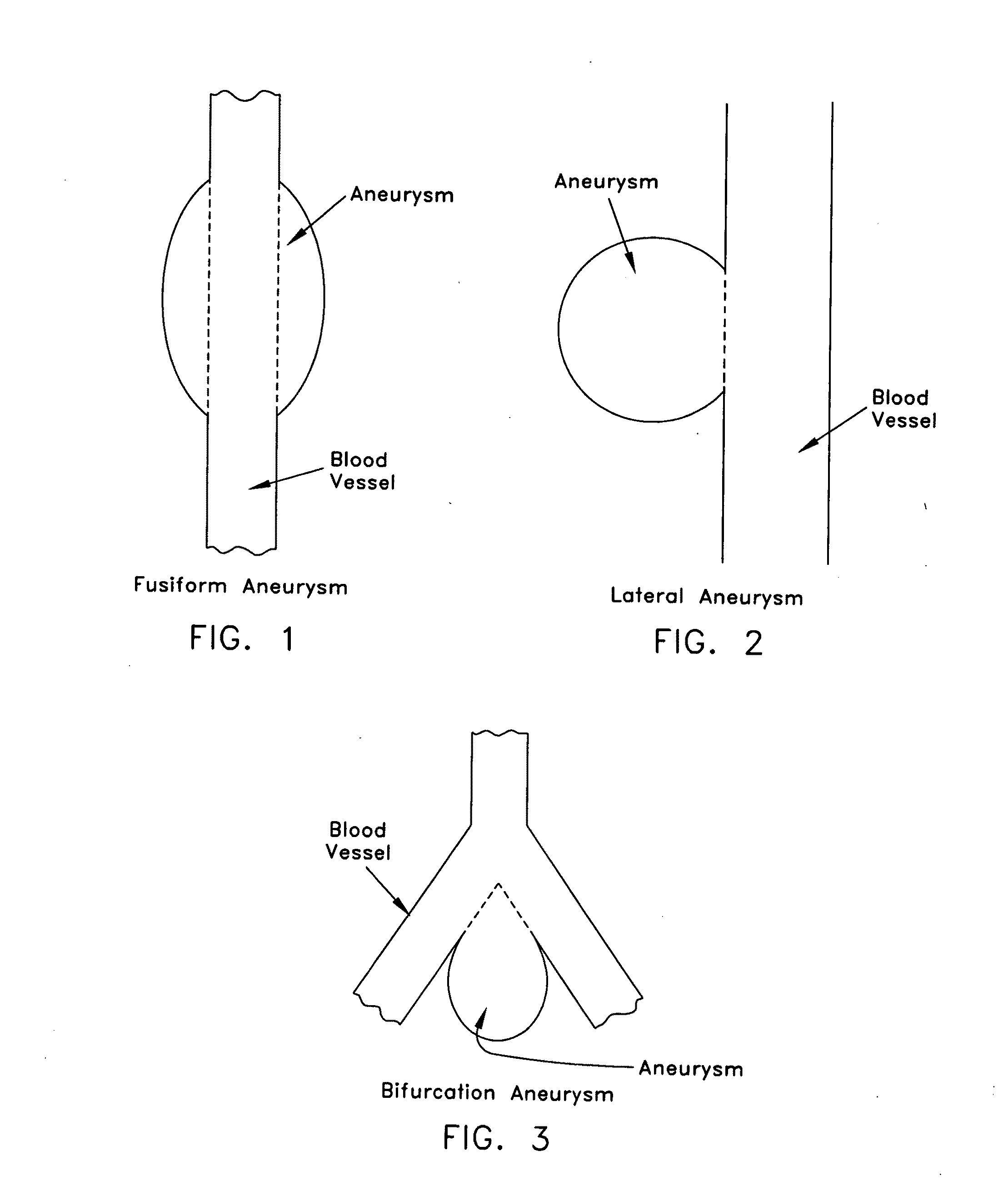 Method and apparatus for sealing an opening in the side wall of a body lumen, and/or for reinforcing a weakness in the side wall of a body lumen, while maintaining substantially normal flow through the body lumen