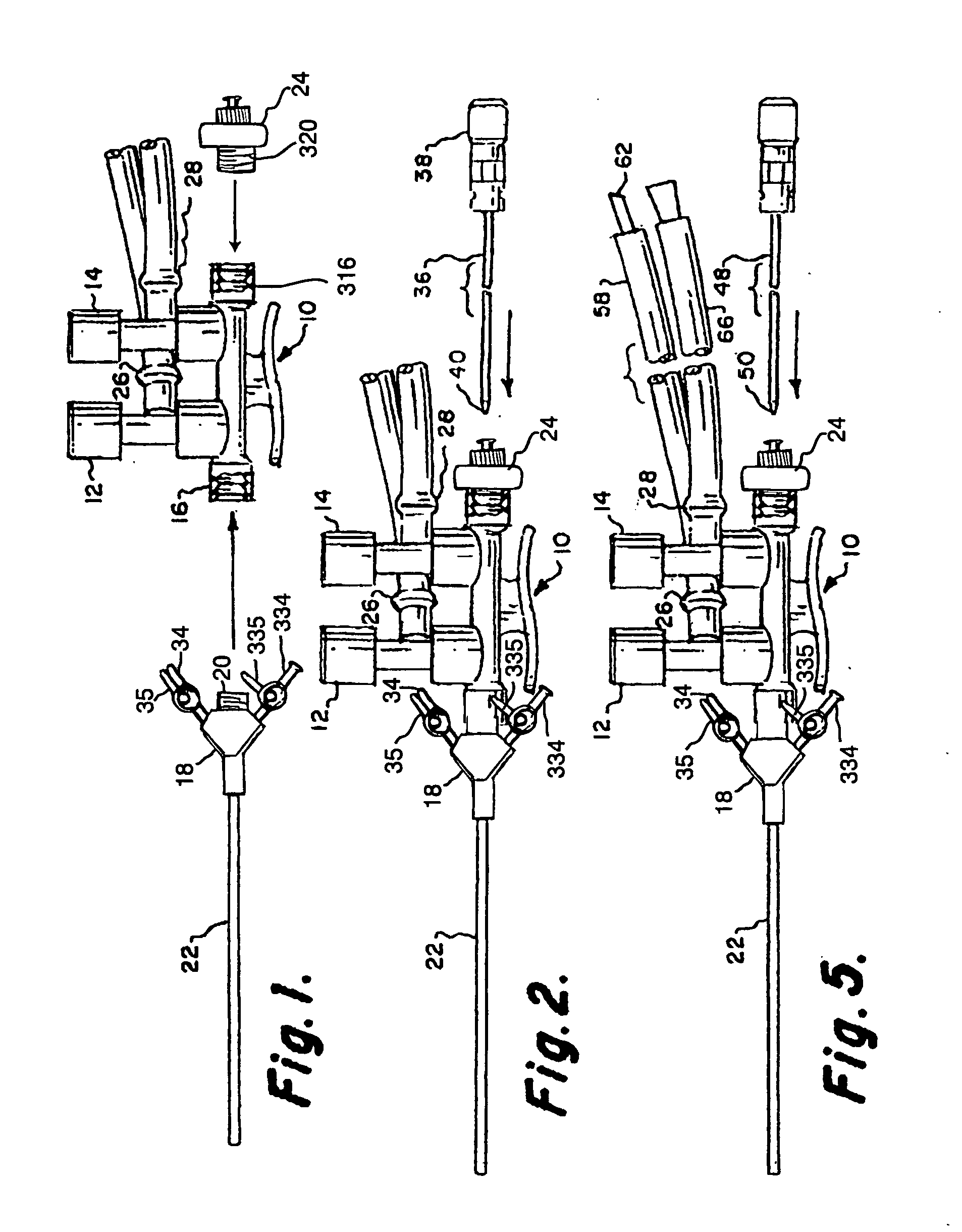 Small single-port arthroscopic lavage, directed tissue drying, biocompatible tissue scaffold and autologous regenerated cell placement delivery system