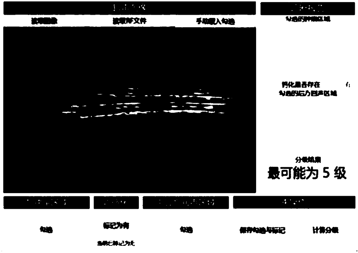 Ultrasound breast tumor grading method based on multi-feature extraction and Linear SVM