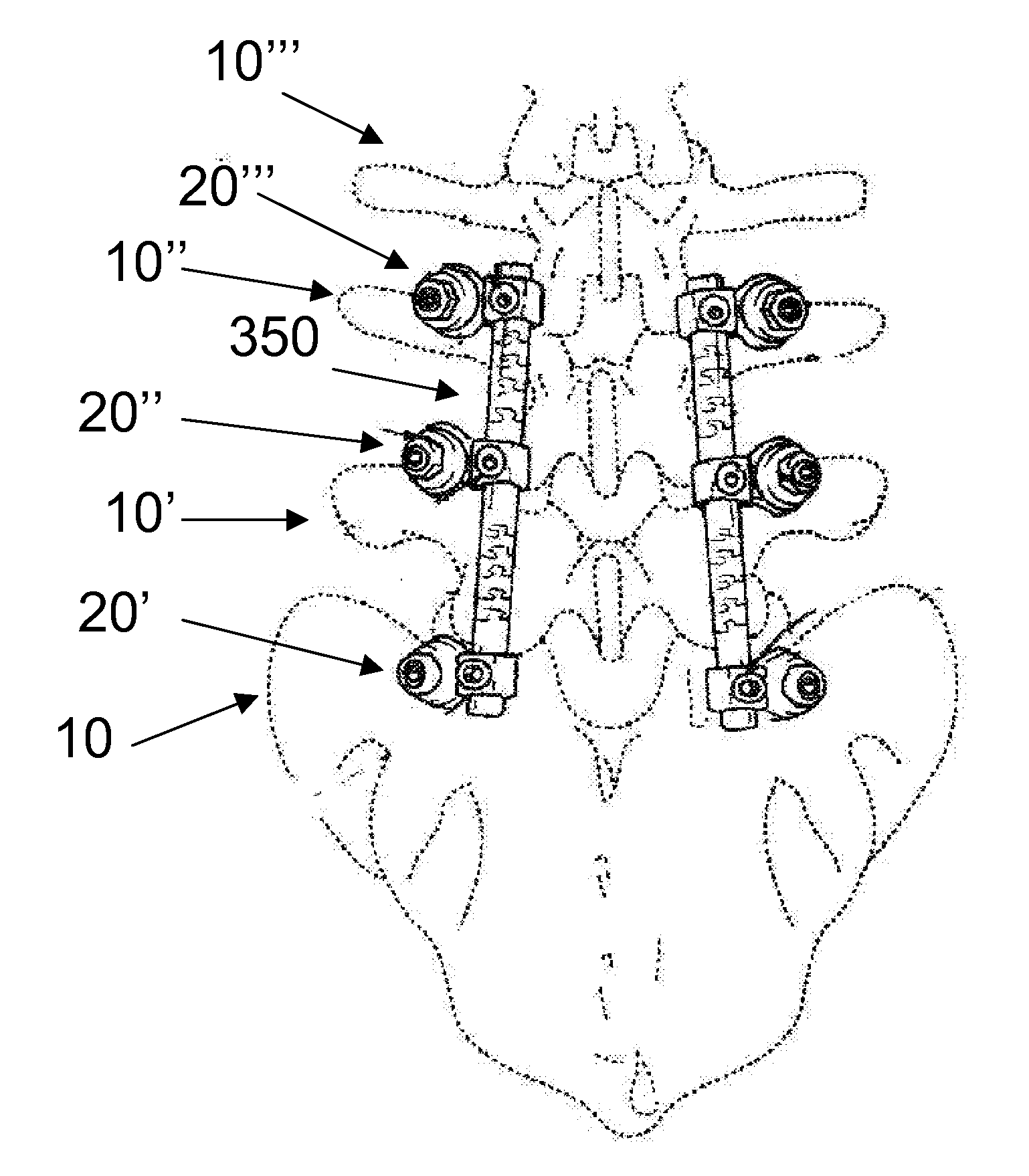 Flexible spine components having a concentric slot