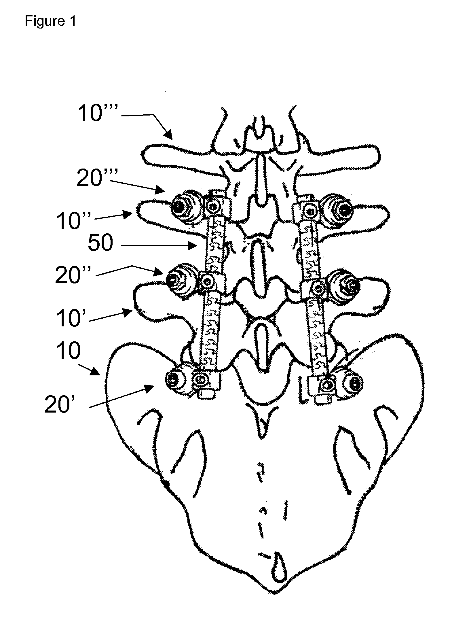 Flexible spine components having a concentric slot