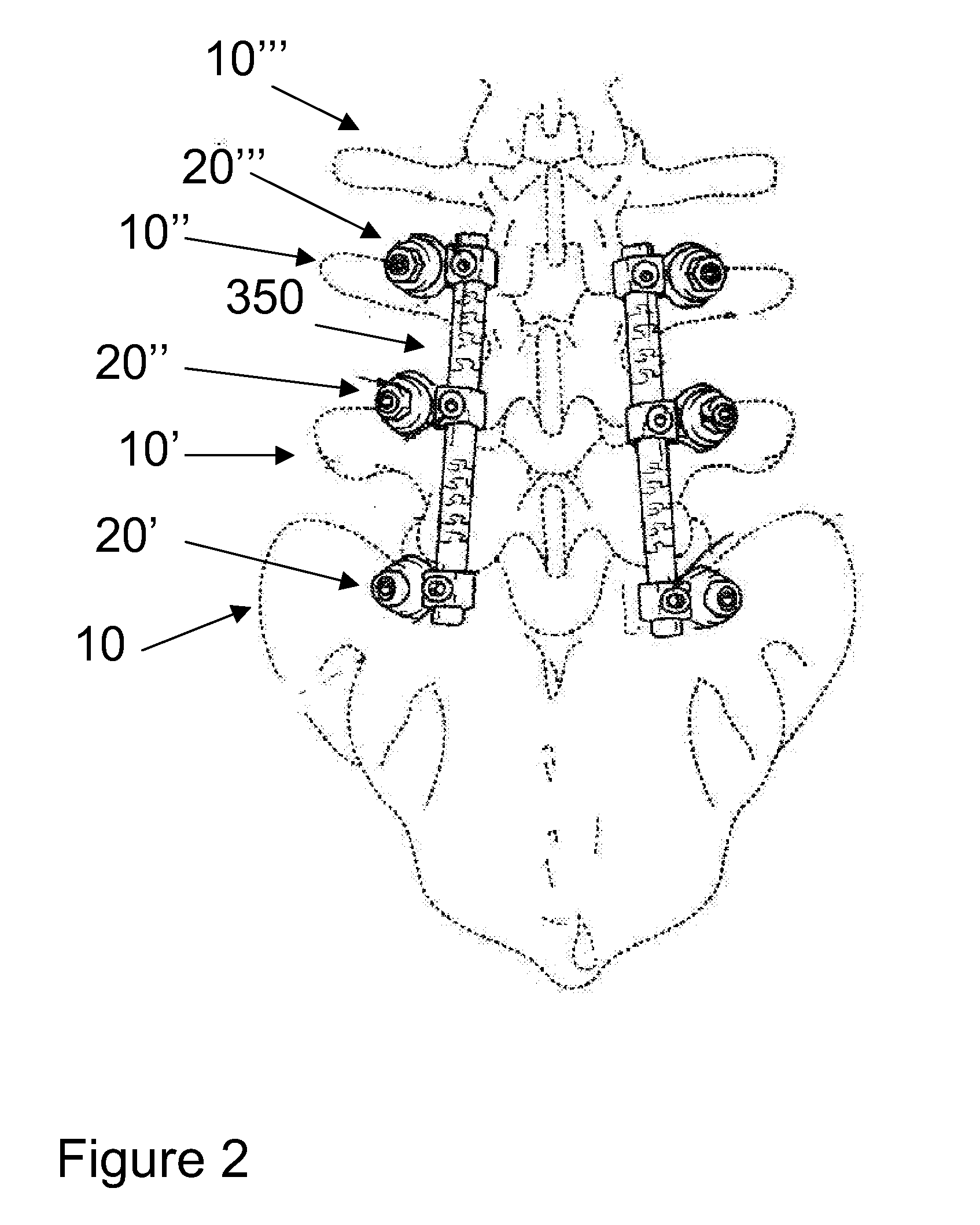 Flexible spine components having a concentric slot