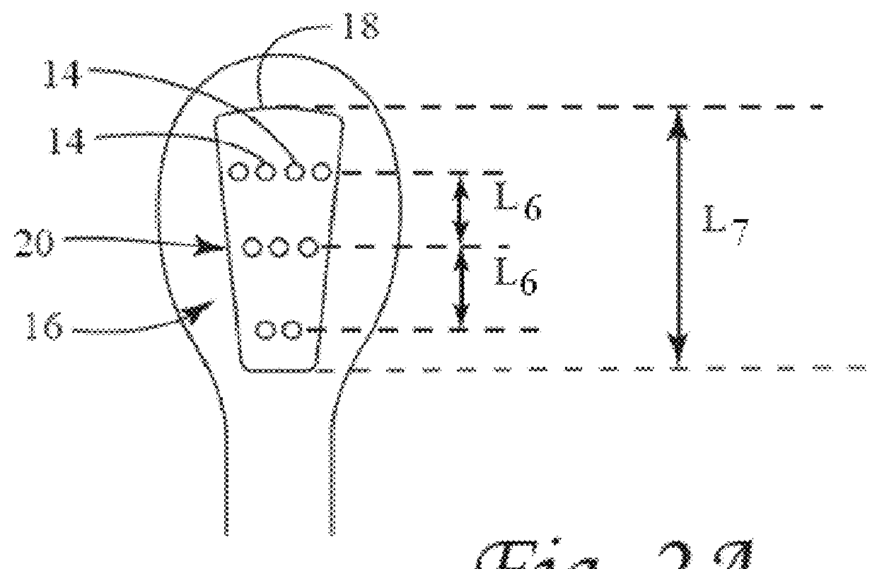 Bladder denervation for treating overactive bladder