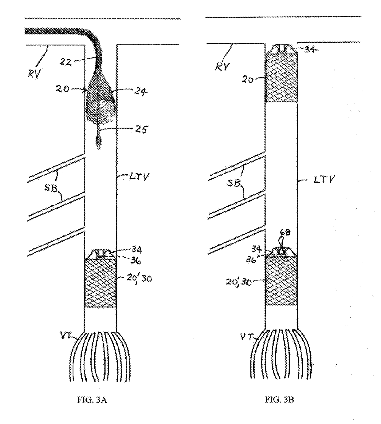 Endovascular occlusive device and associated surgical methodology