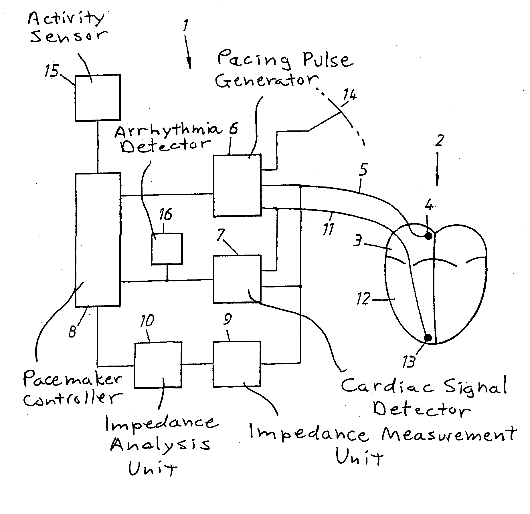 Heart stimulator detecting atrial arrhythmia by determing wall distension by impedance measuring