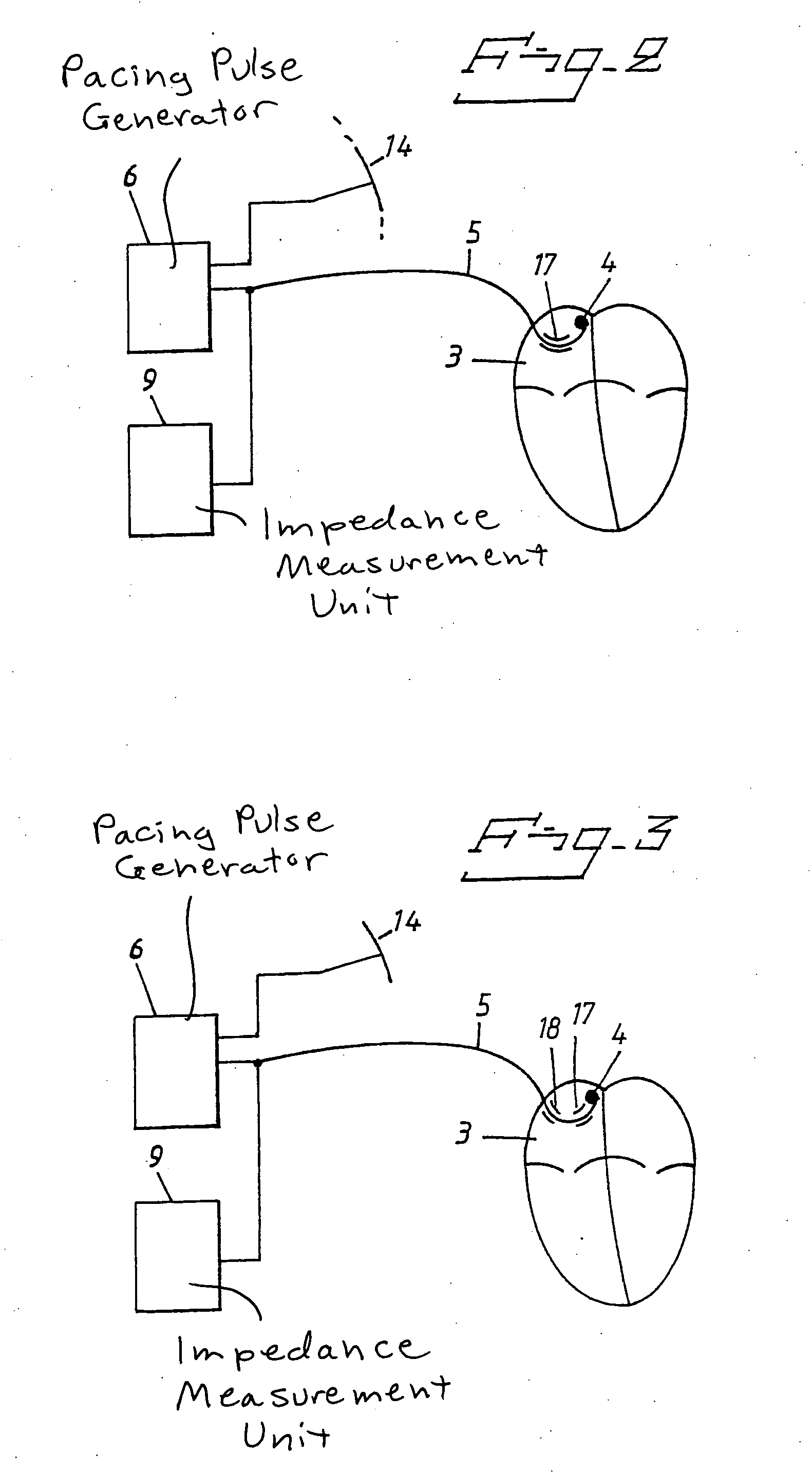 Heart stimulator detecting atrial arrhythmia by determing wall distension by impedance measuring