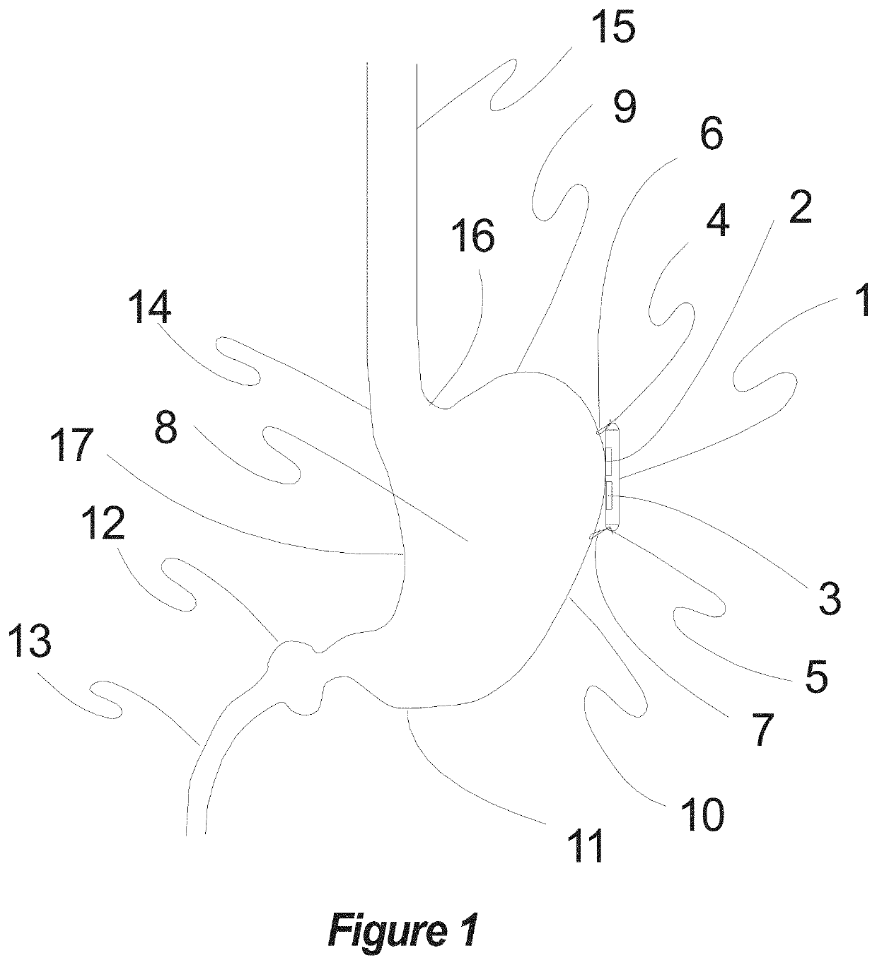 Method, apparatus, surgical technique, and optimal stimulation parameters for noninvasive & minimally invasive autonomic vector neuromodulation for the treatment of obesity, cardiac disease, pulmonary disorders, hypertension, and other conditions