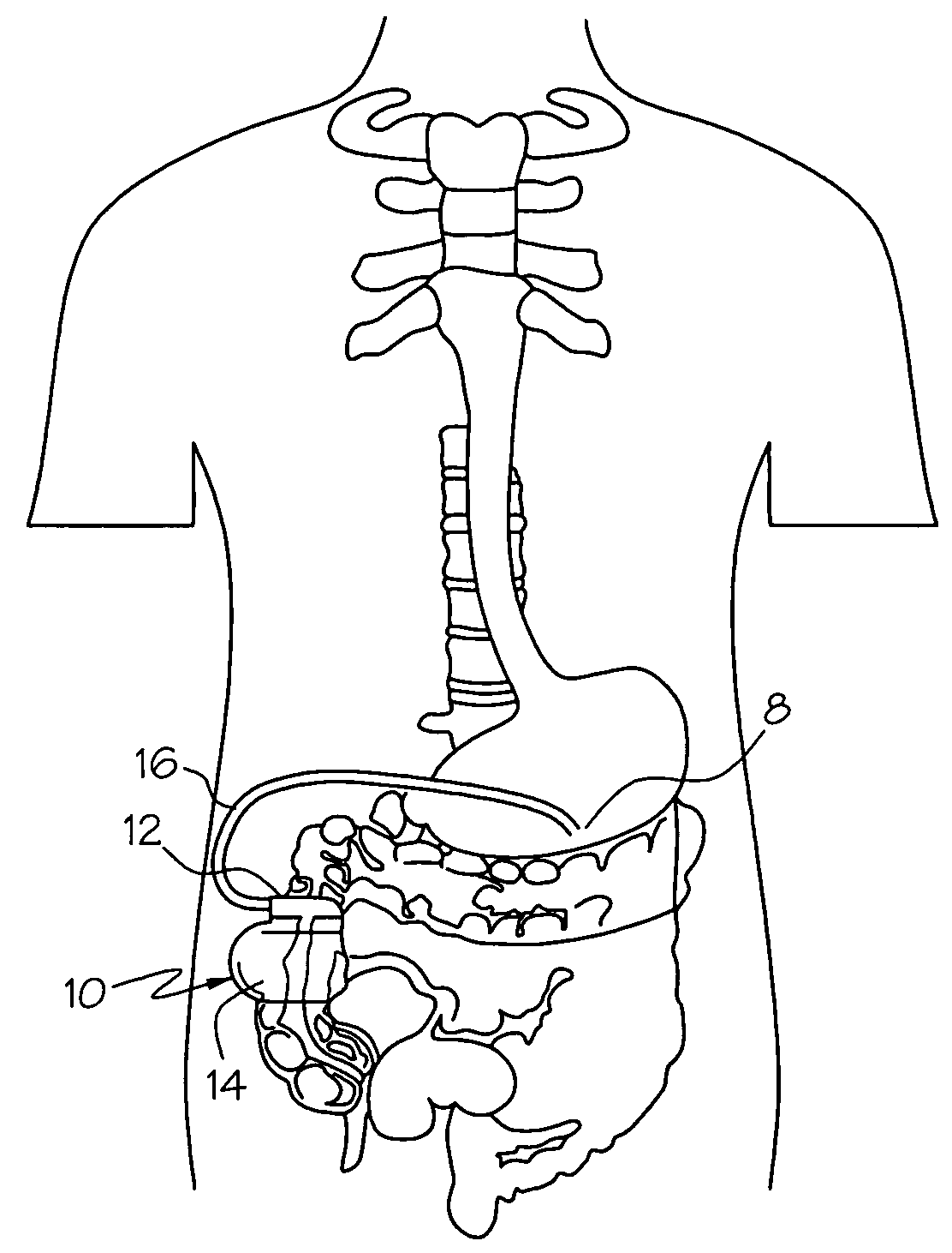 Gastro-electric stimulation for reducing the acidity of gastric secretions or reducing the amounts thereof