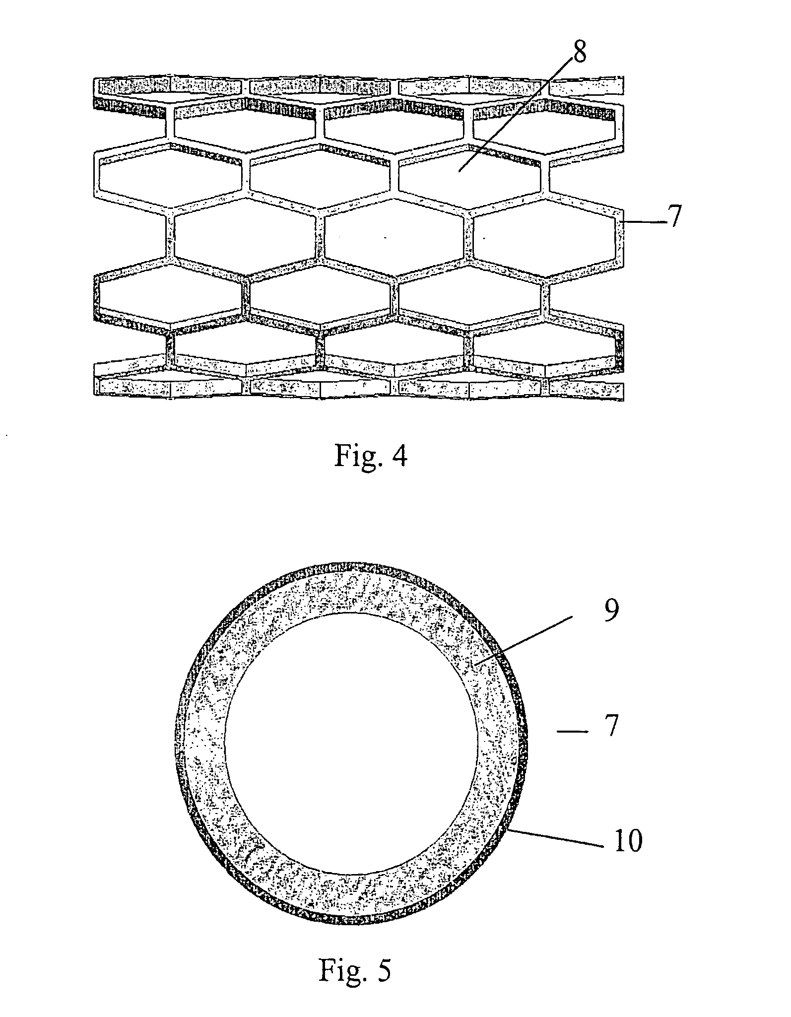 Stent