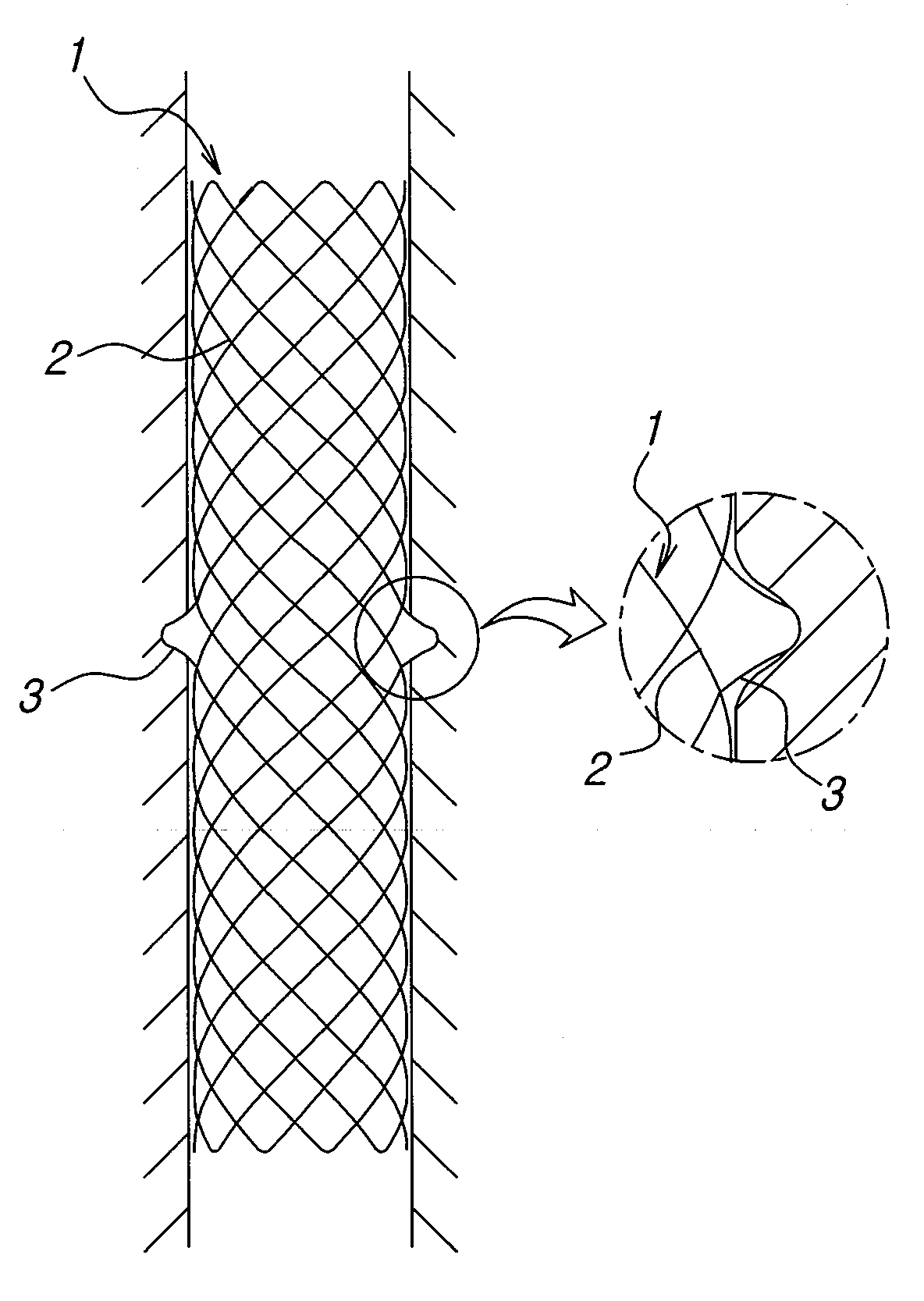 Biodegradable double stent