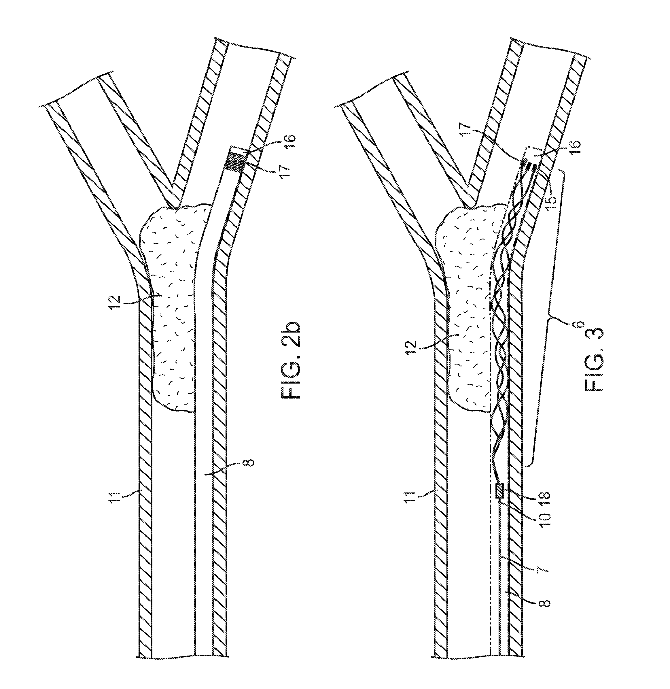 Methods and apparatus for flow restoration