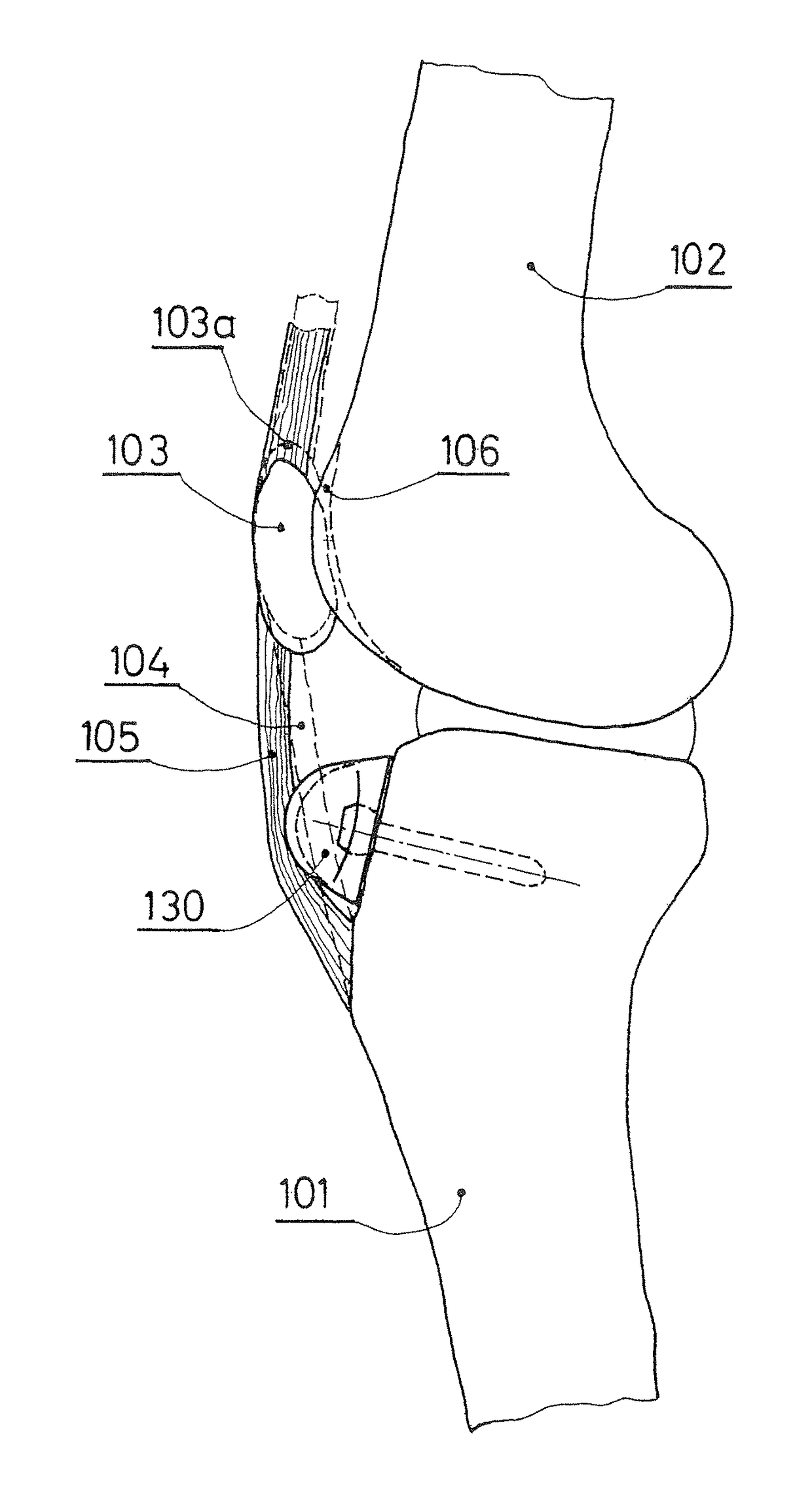 Patellar ligament spacer for ACL injuries