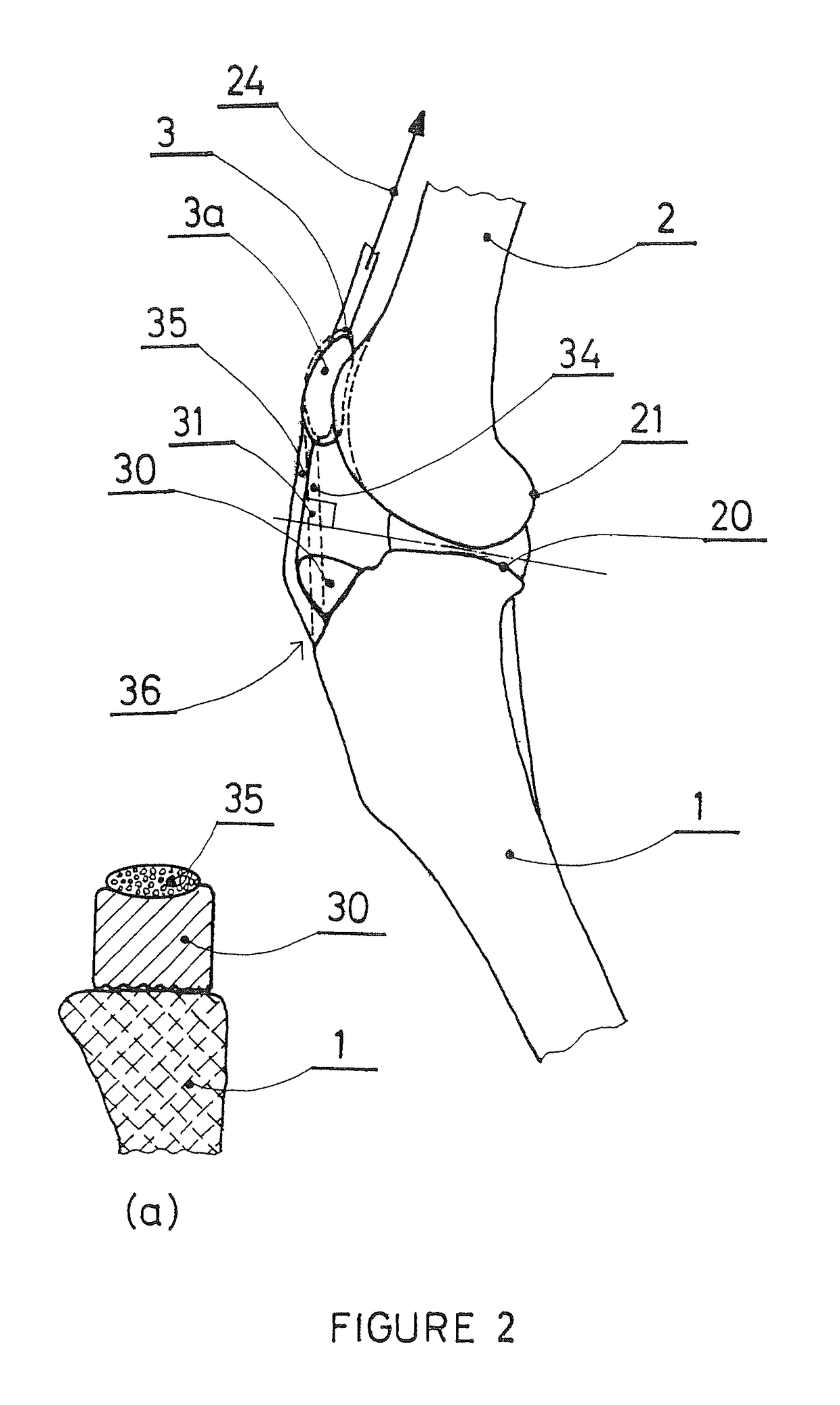 Patellar ligament spacer for ACL injuries