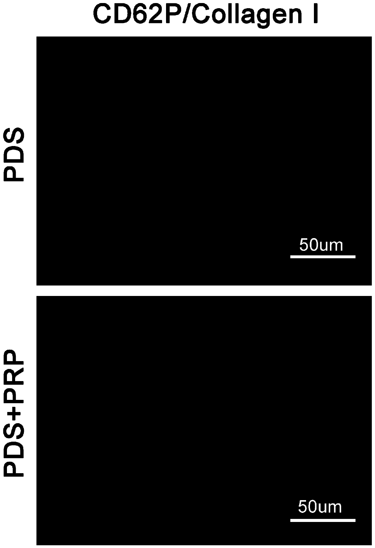 Platelet-rich plasma (PRP)-loaded pancreatic decellularized scaffold and preparation method thereof