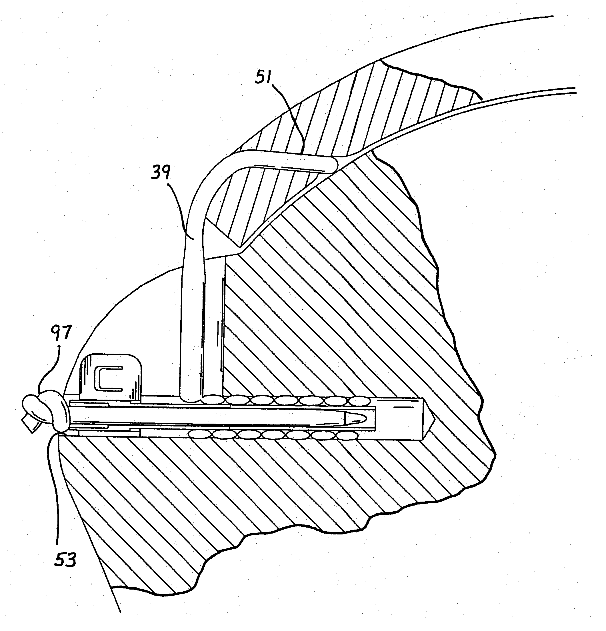 Methods for attaching connective tissues to bone using a multi-component anchor