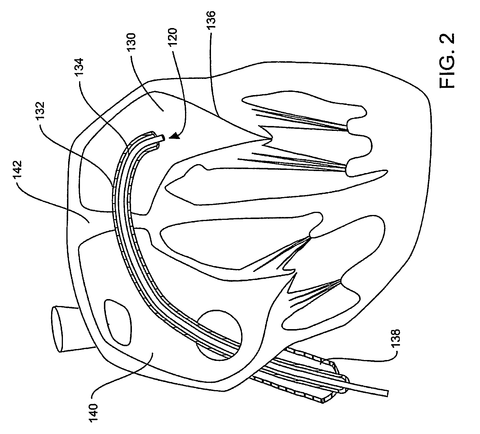 Cardiac valve annulus reduction system