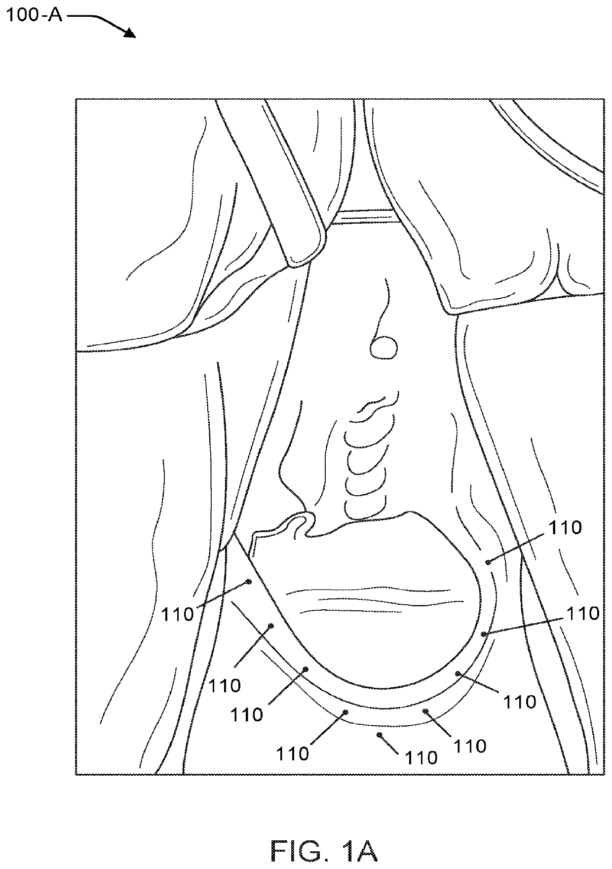 Vaginal rejuvenation methods and devices