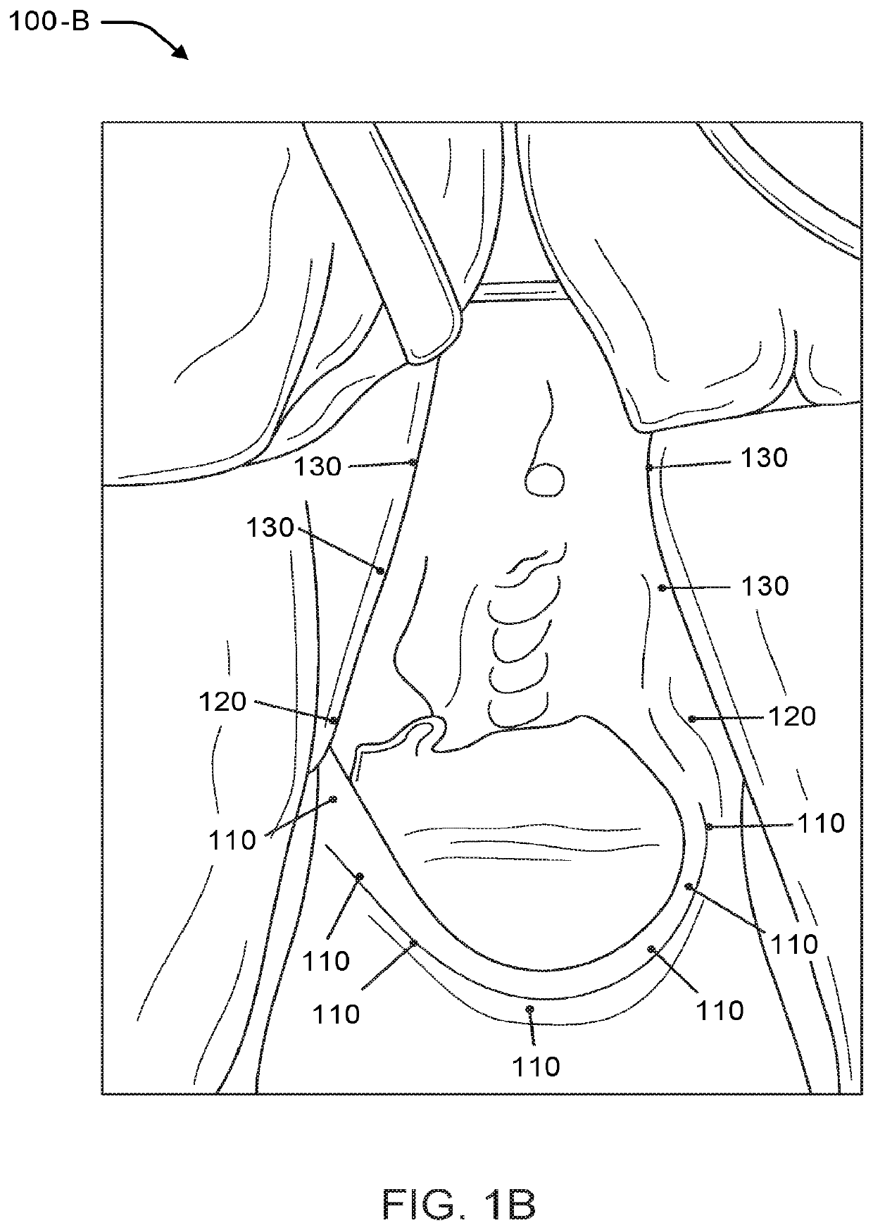 Vaginal rejuvenation methods and devices