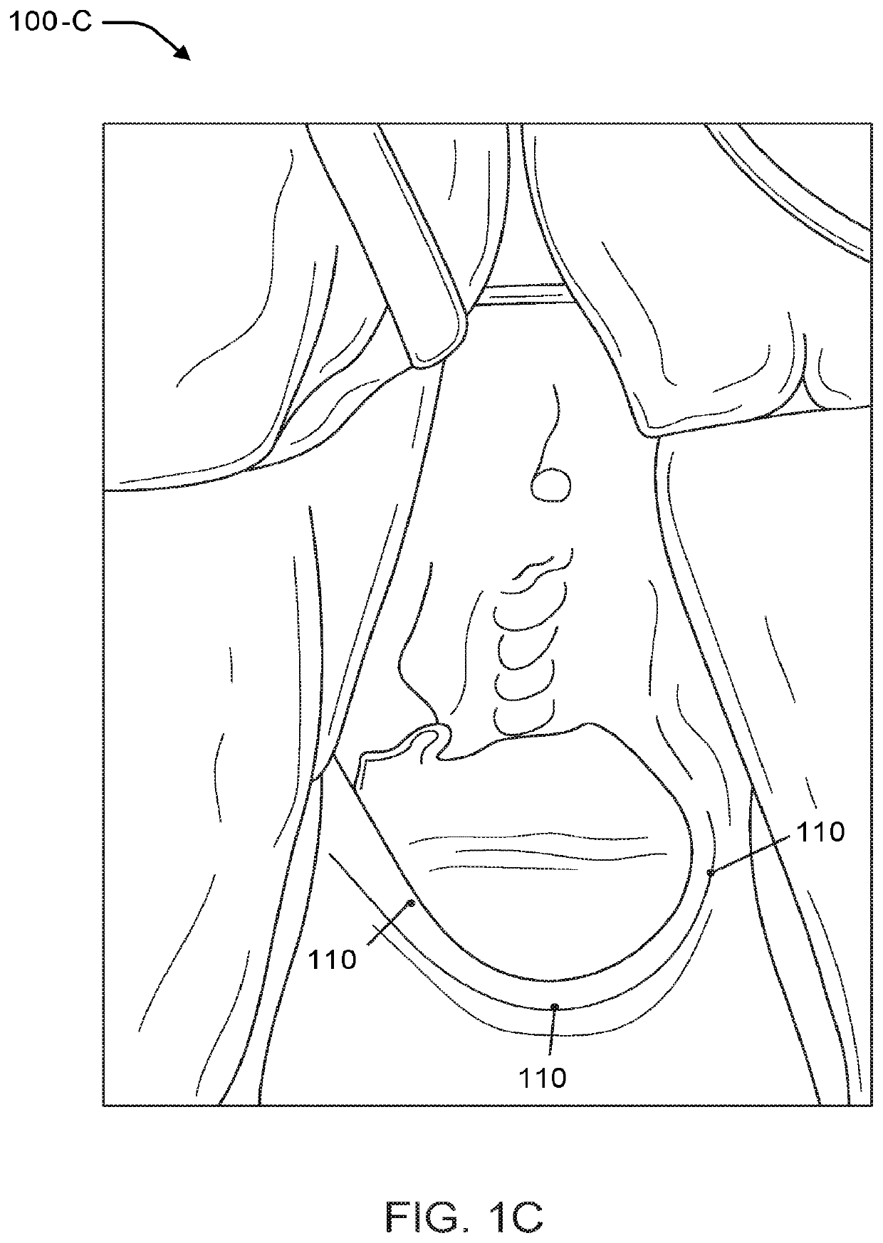 Vaginal rejuvenation methods and devices