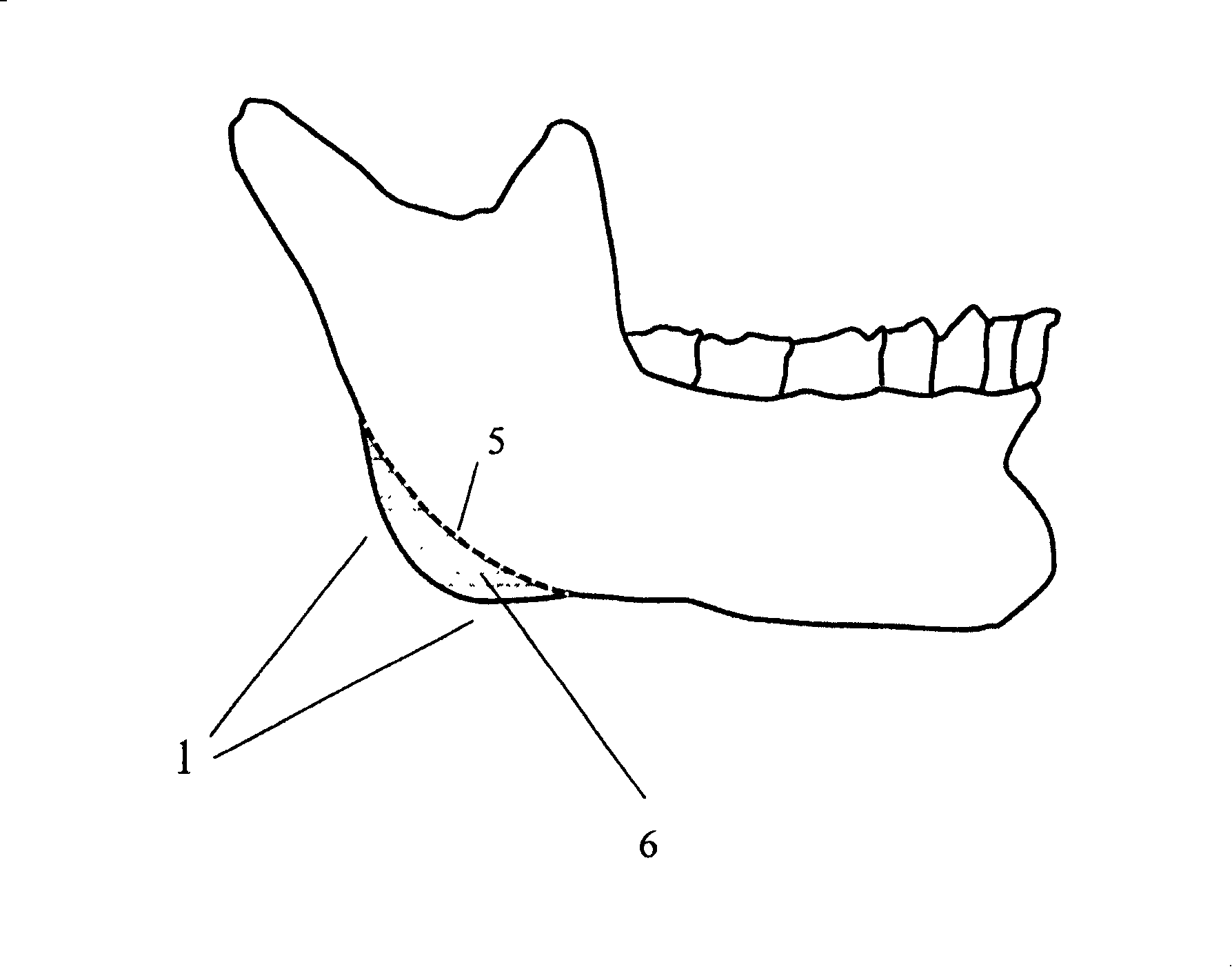 Shaping-area limiting device for angle of mandible and making method therefor