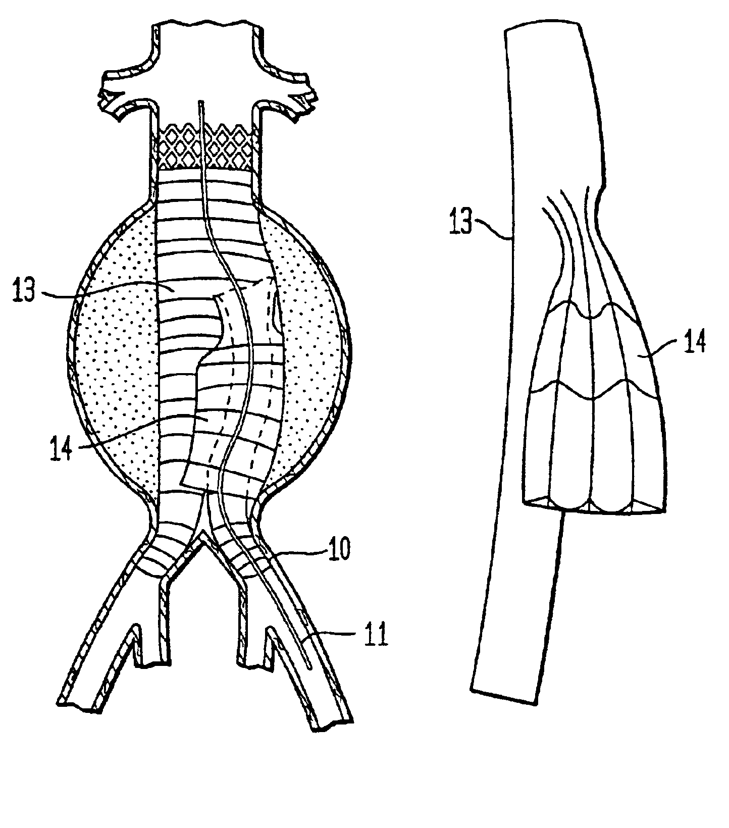 Arterial graft device