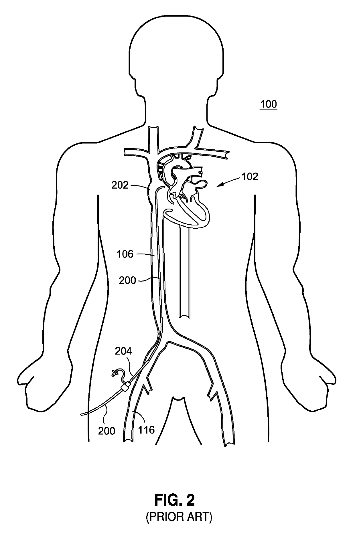 System and method for implant delivery