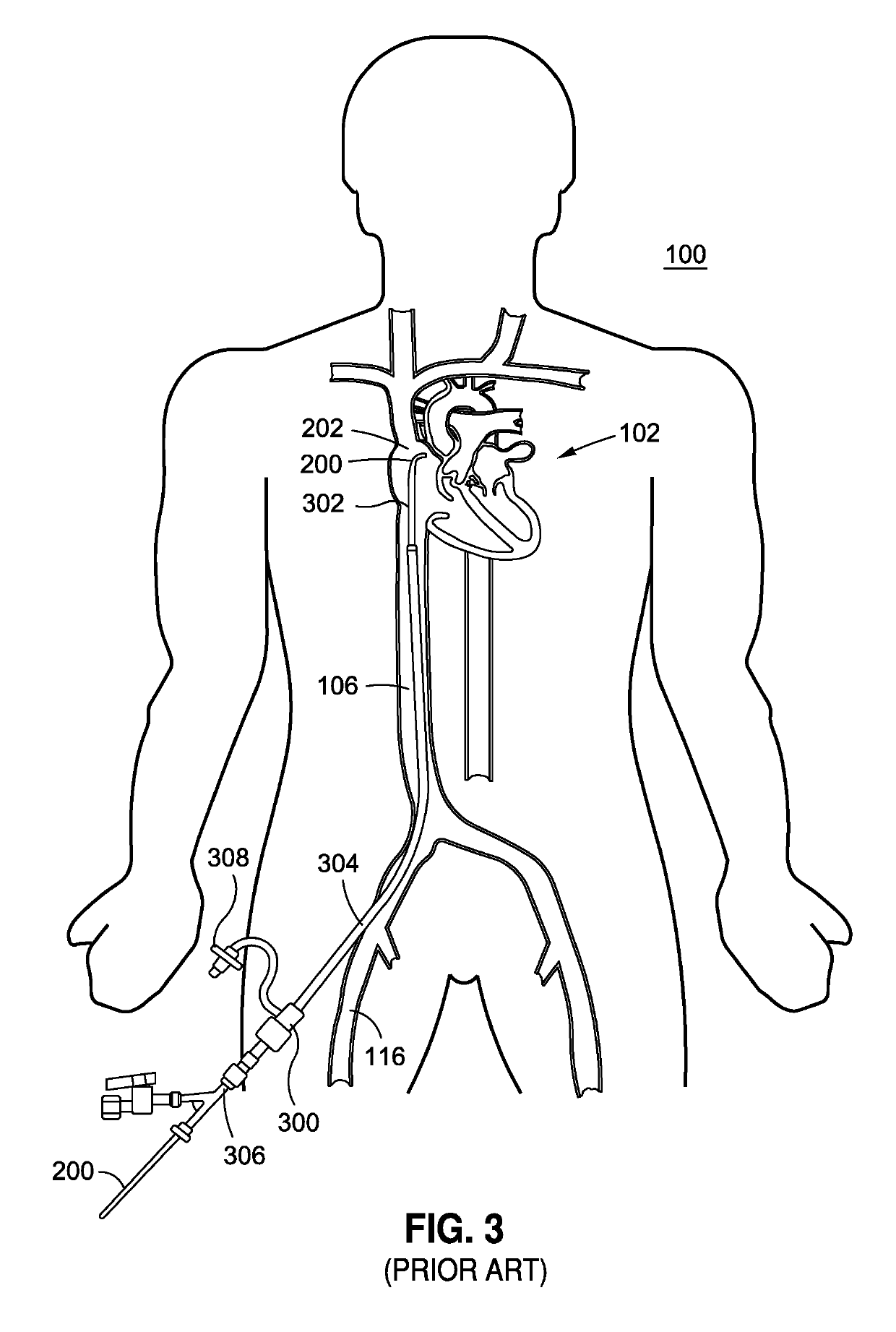 System and method for implant delivery