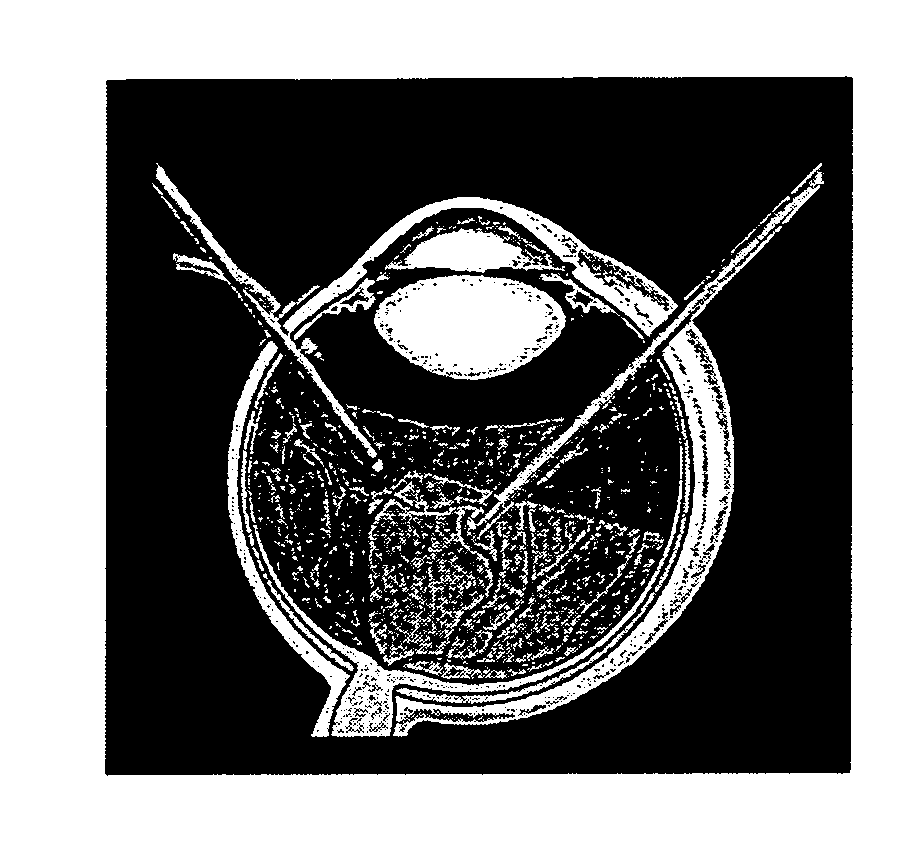 Compound subretinal prostheses with extra-ocular parts and surgical technique therefore