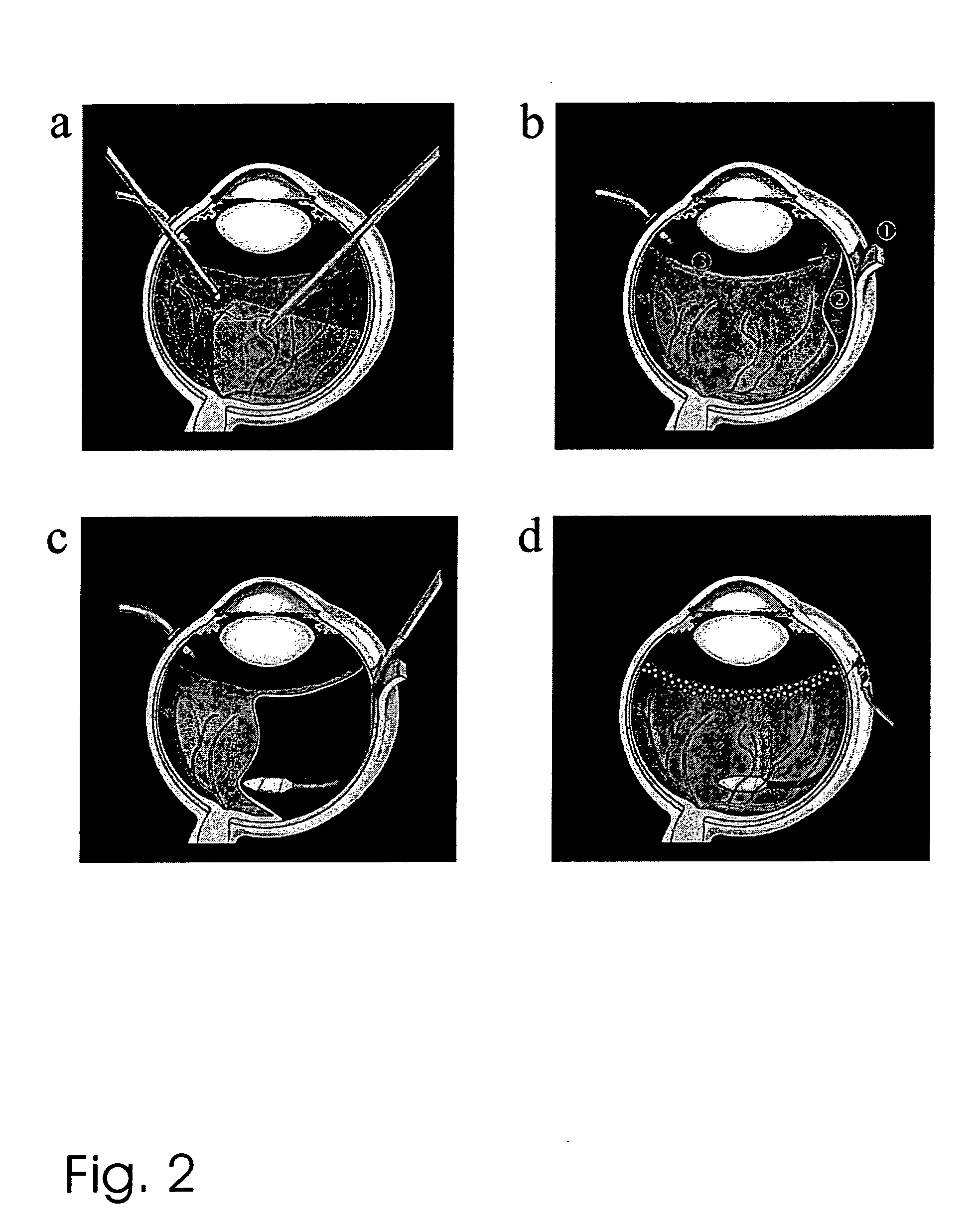 Compound subretinal prostheses with extra-ocular parts and surgical technique therefore