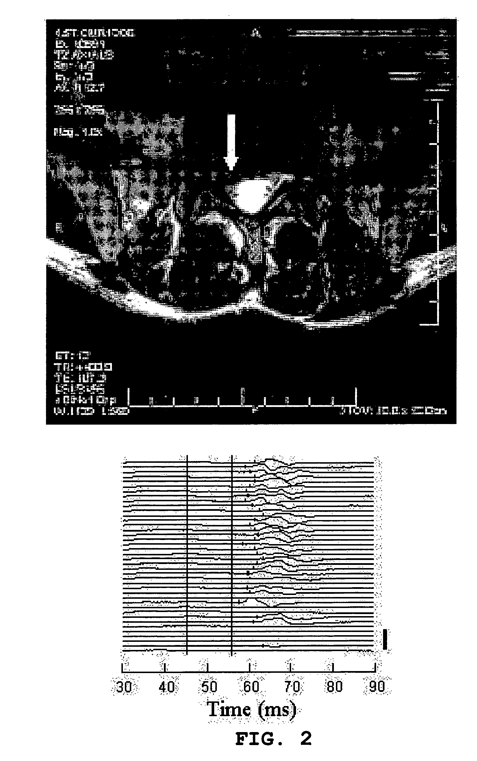 Method and apparatus for the detection of neuromuscular disease using disease specific evoked neuromuscular response analysis