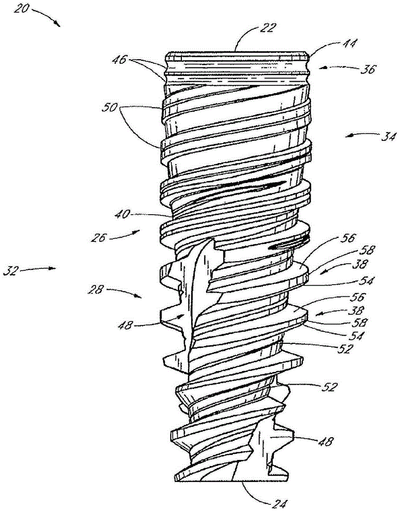 Tooth implant